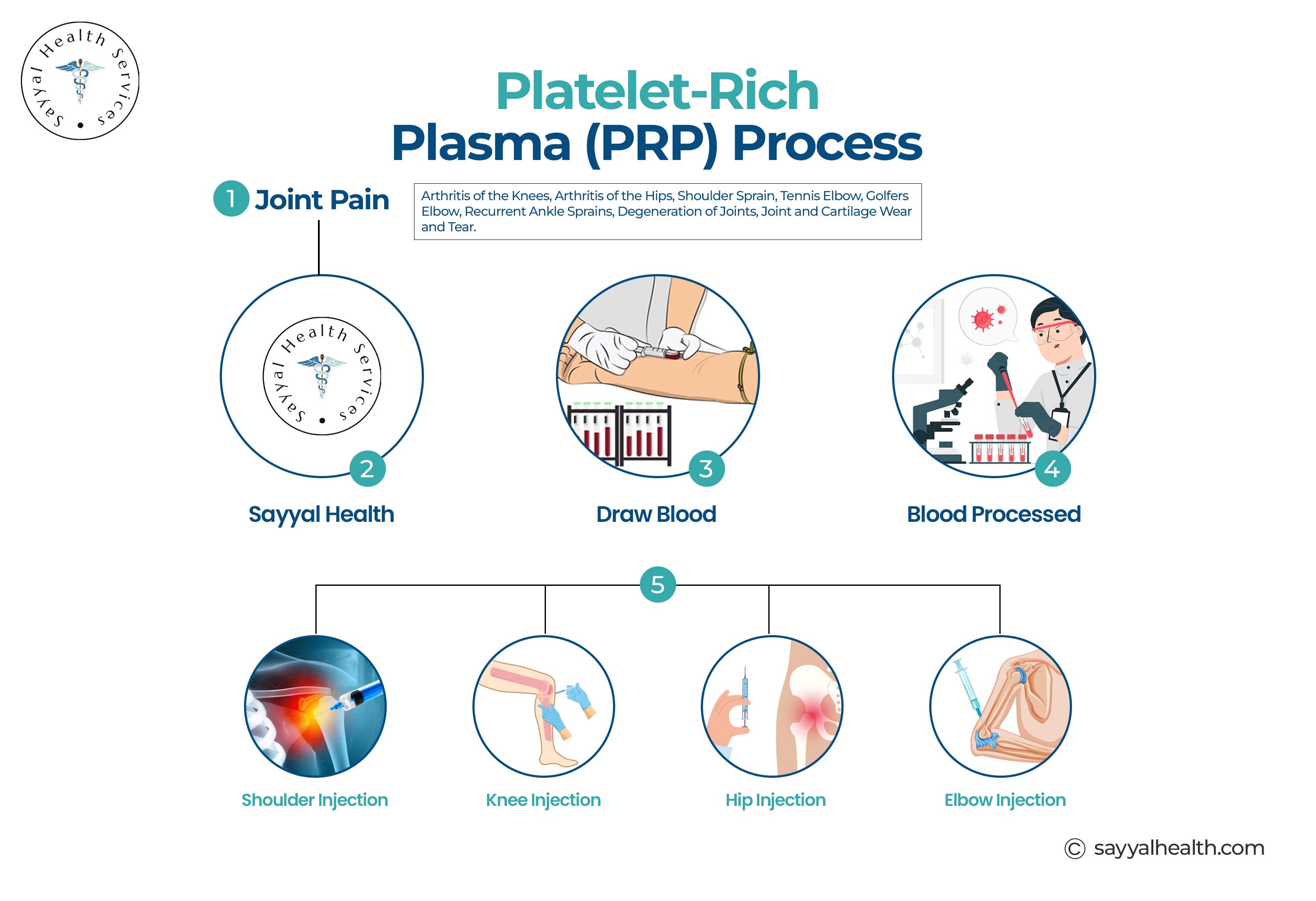 This image shows the platelet rich plasma process.