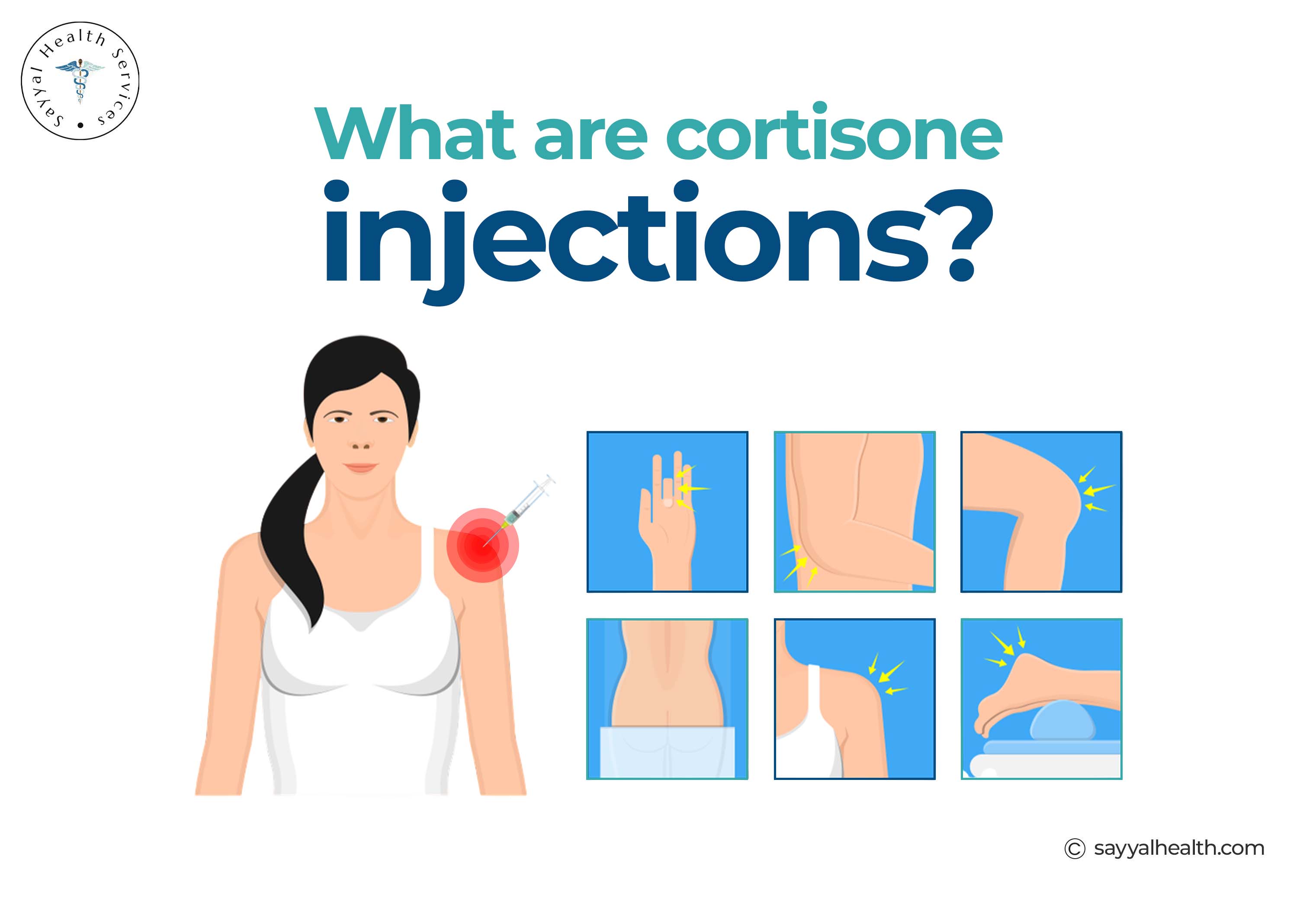 Cortisone injection sites on the body