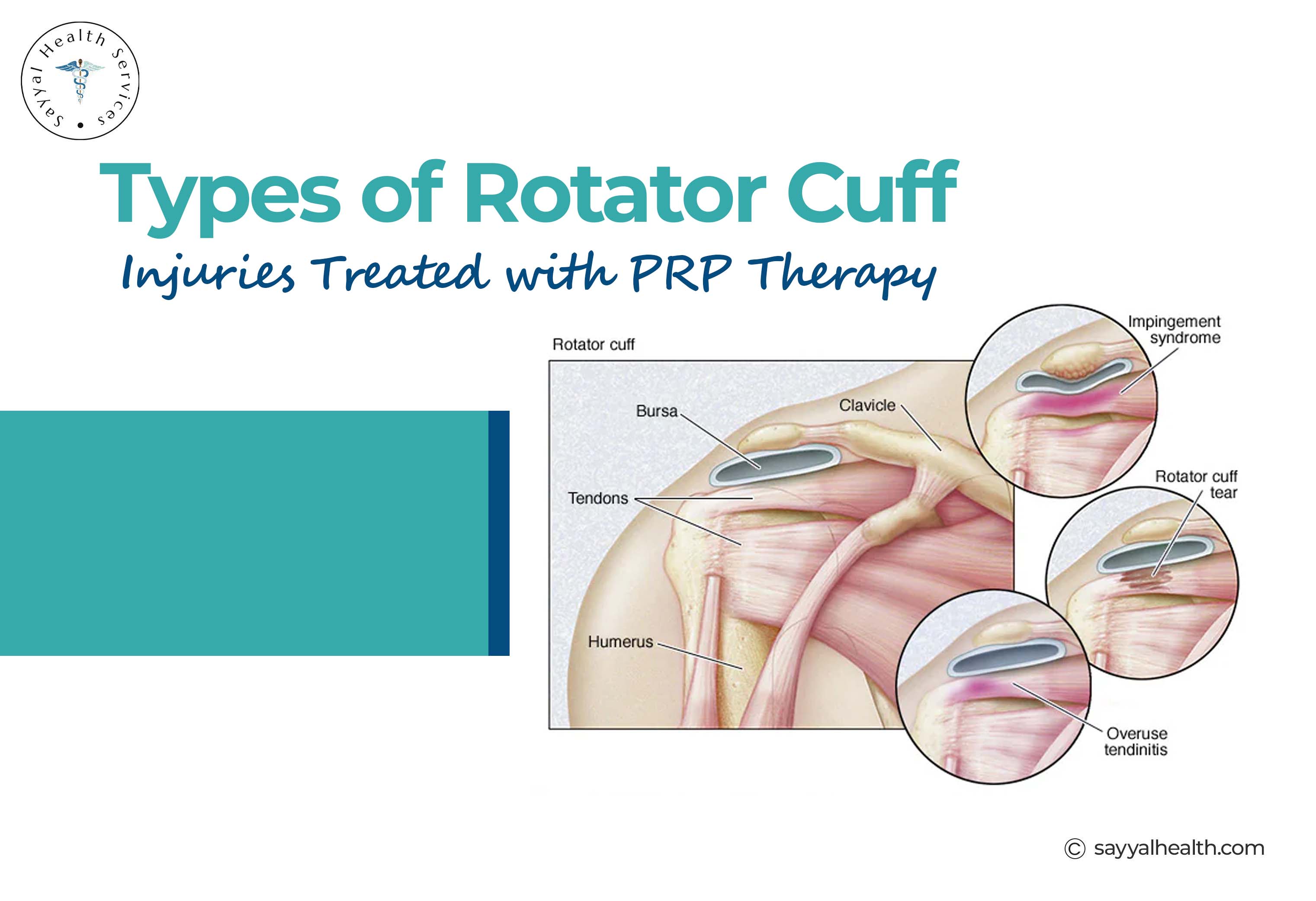 types of rotator cuff injury