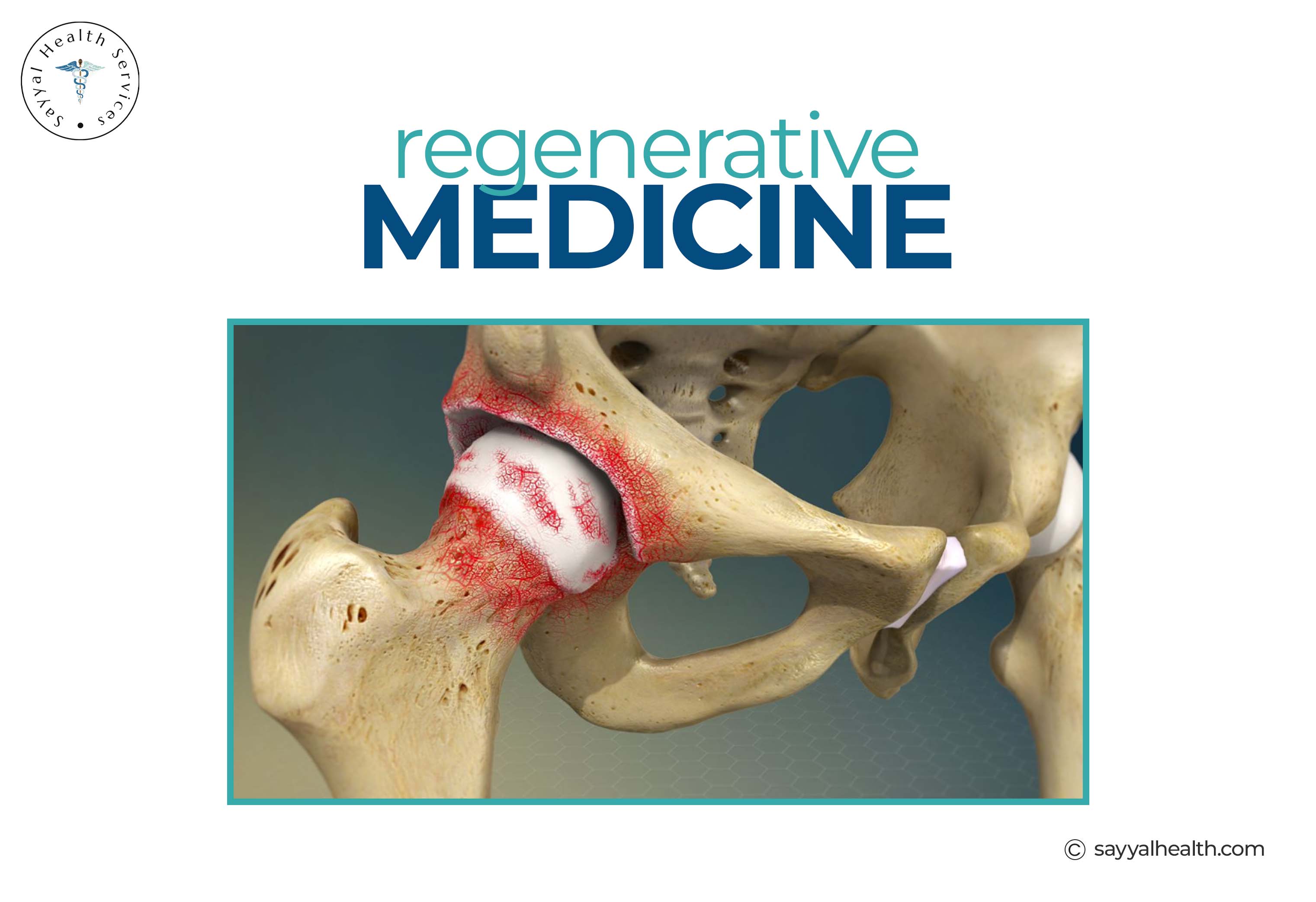 image is showing the hip arthritis