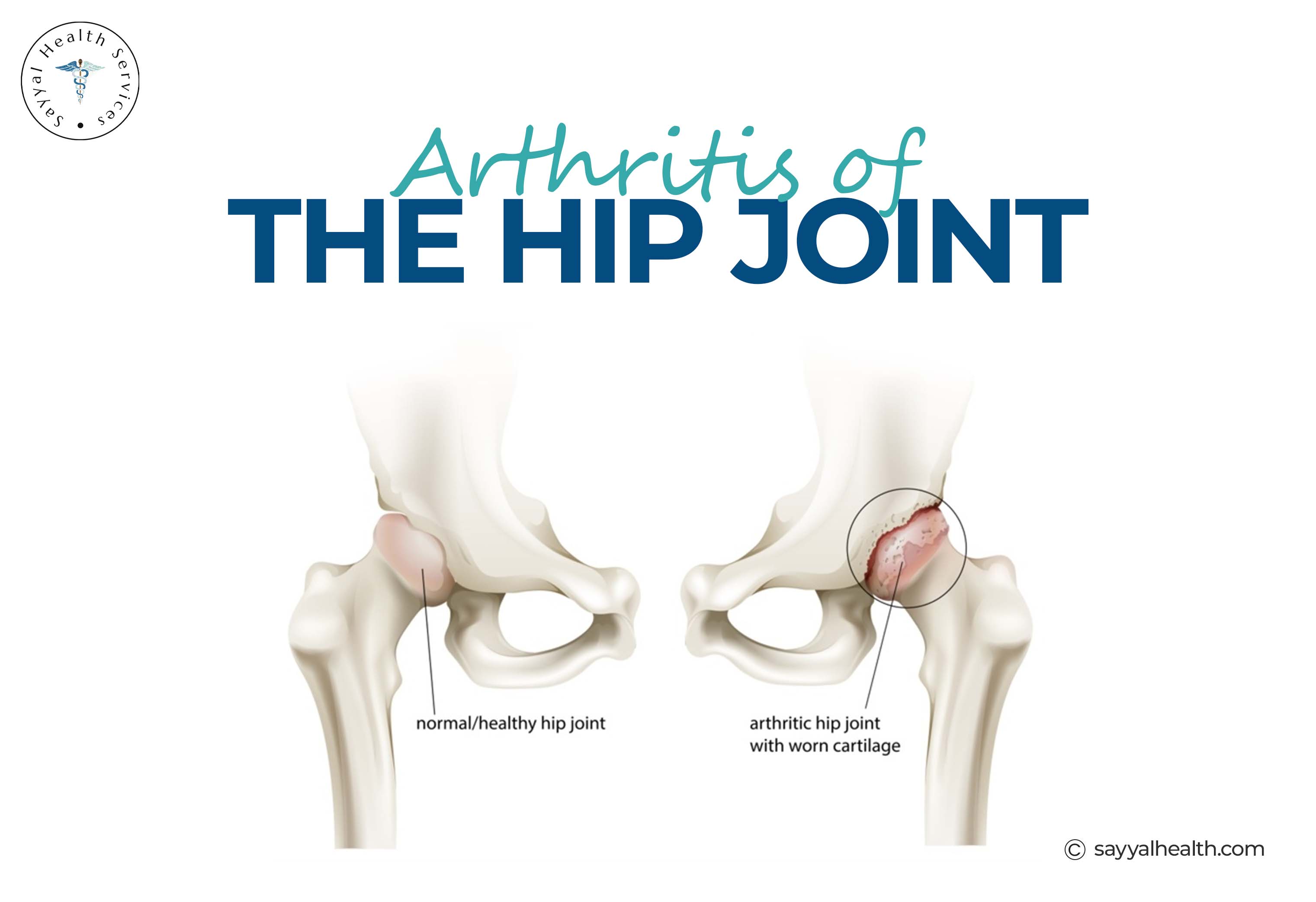 Image shows the arthritis of the Hip Joints.