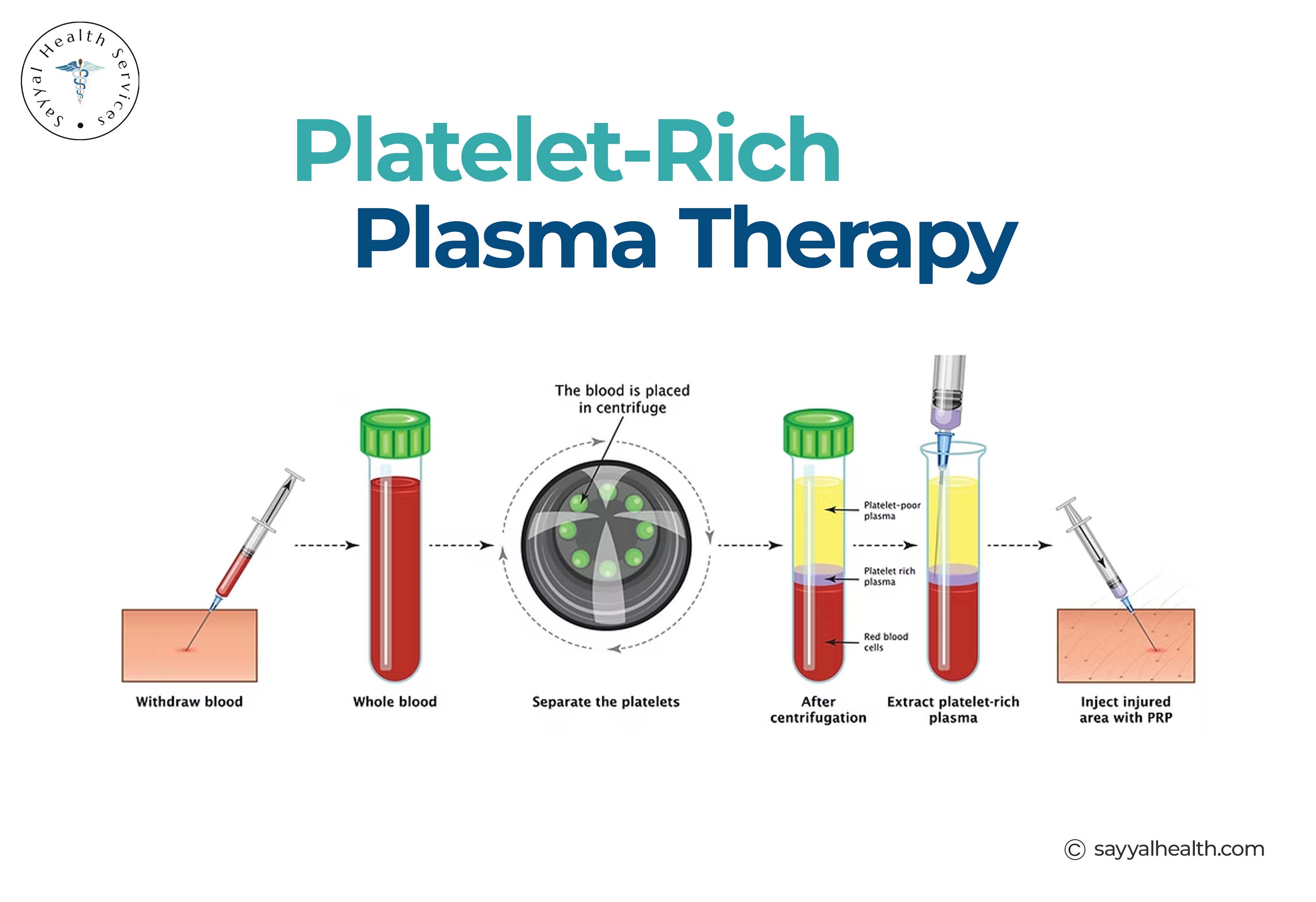 This image shows the overall process of PRP injection.
