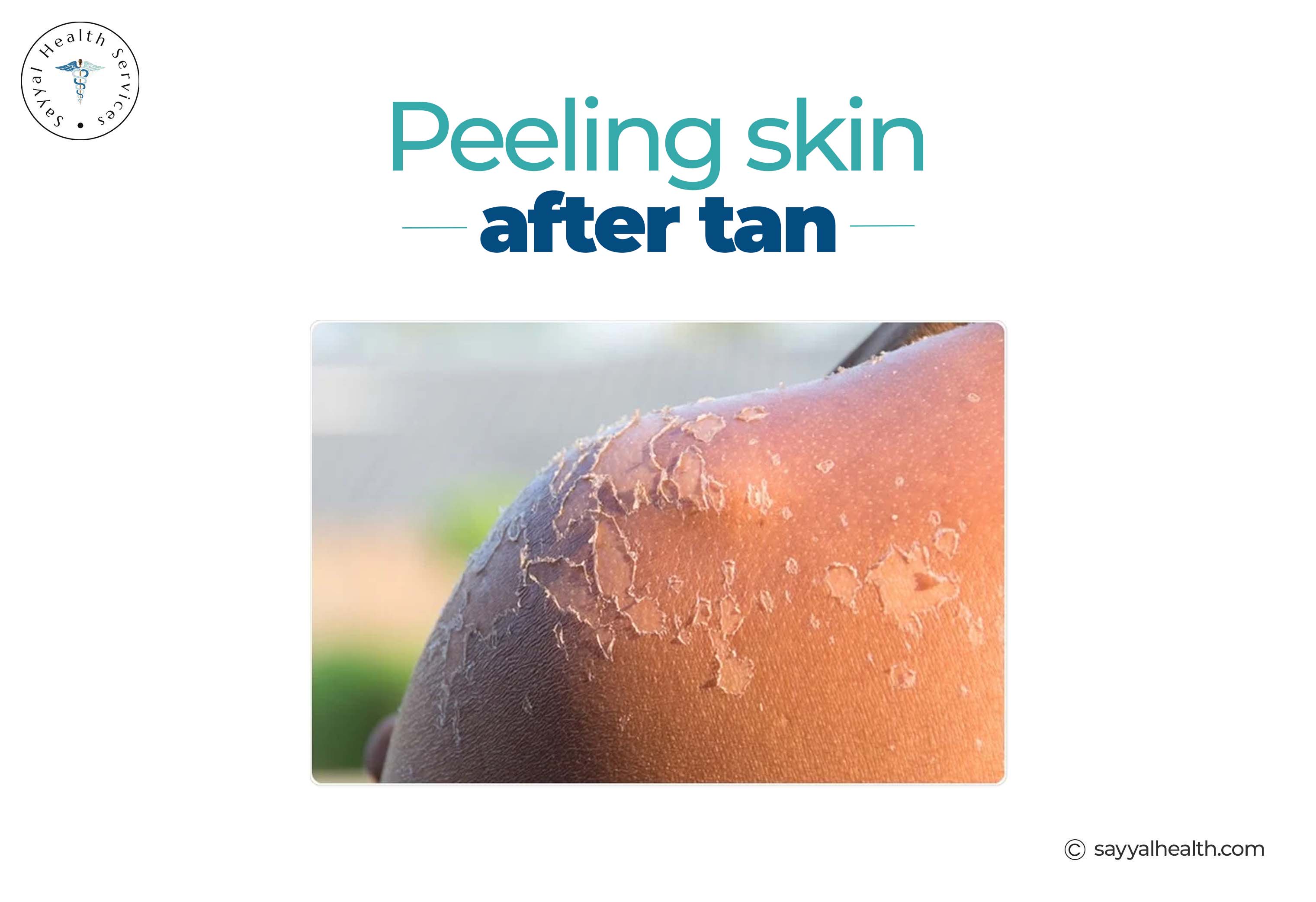 Peeling Skin after Tan