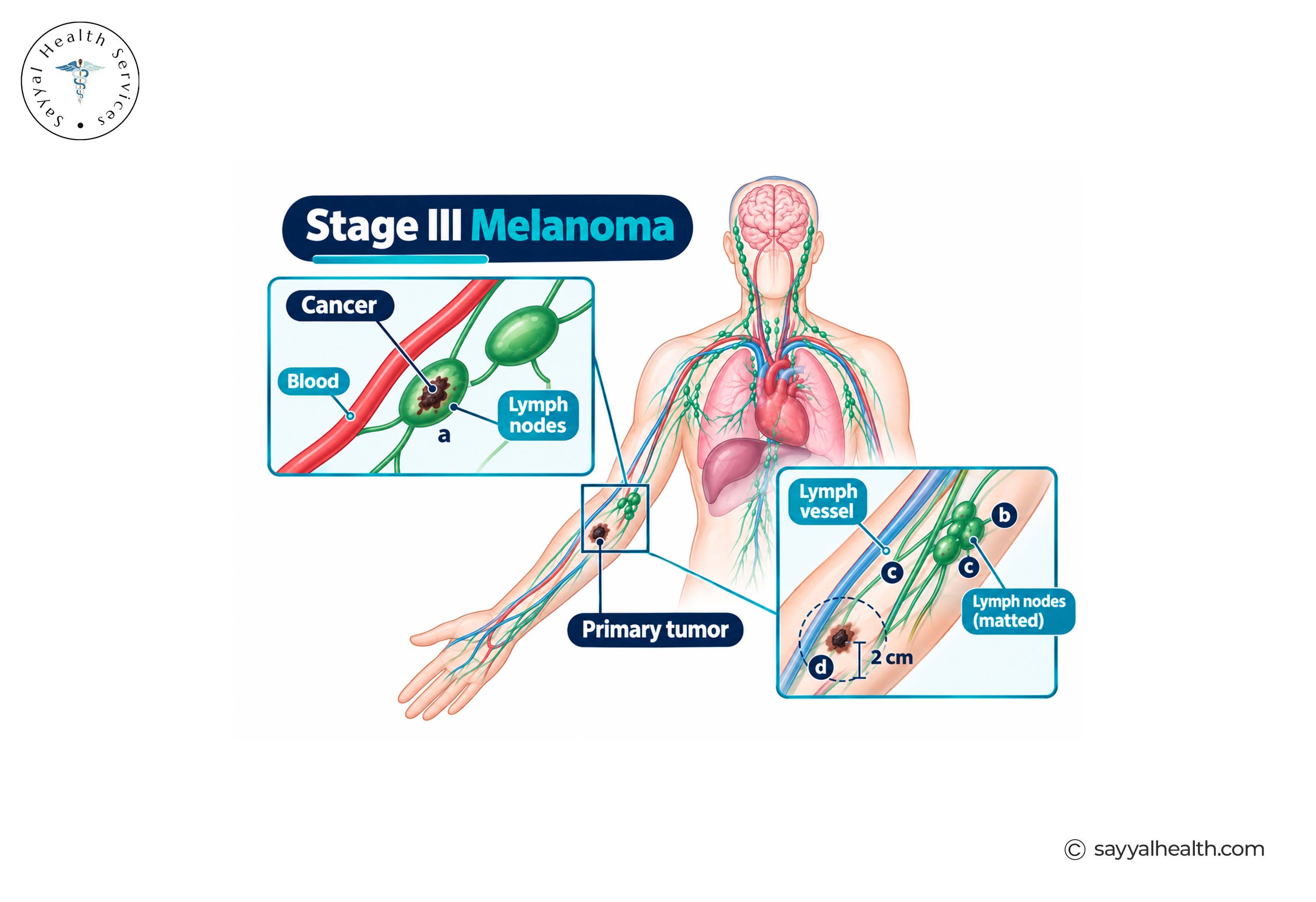 stage 3 melanoma