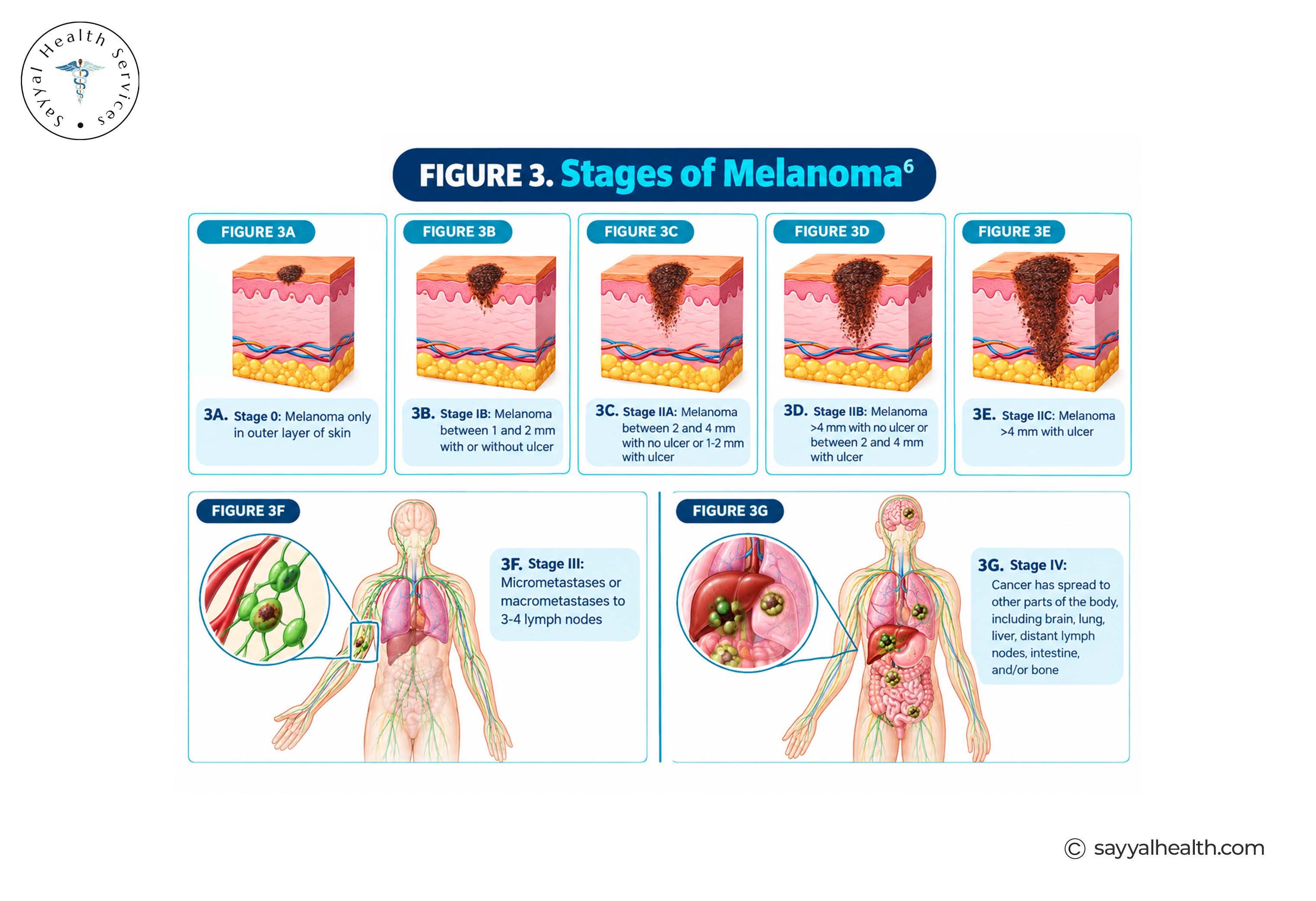 stages of melanoma