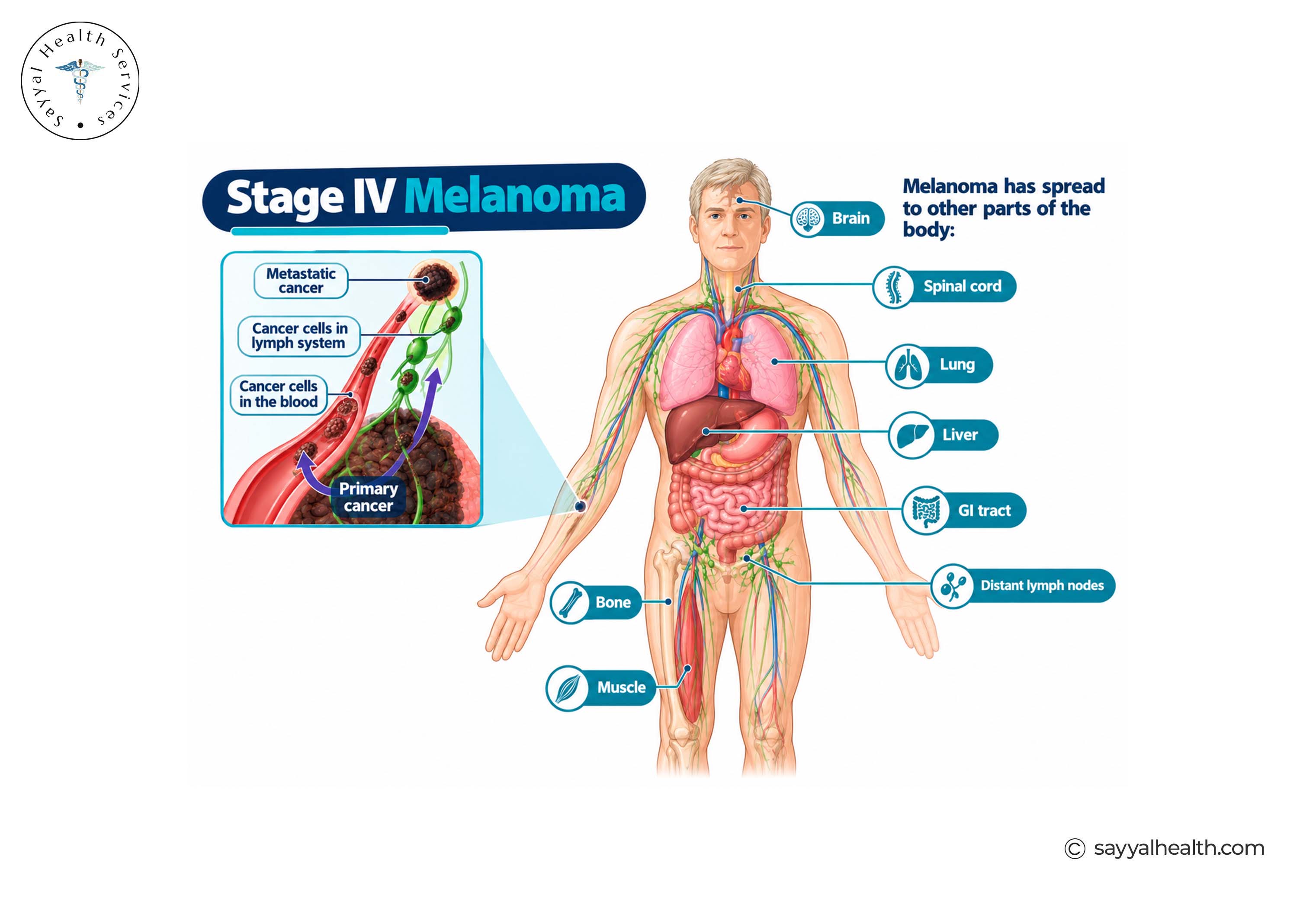 stage 4 melanoma