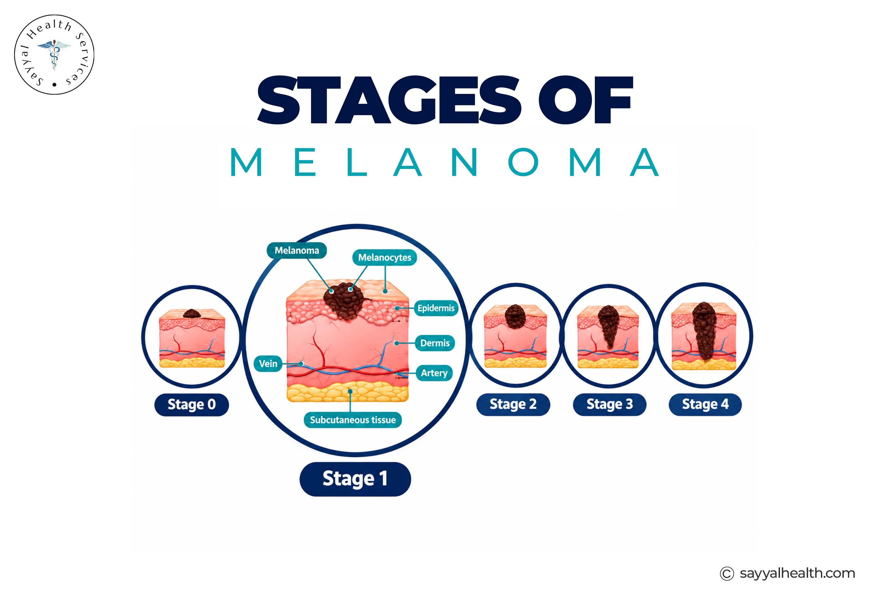 stages of melanoma