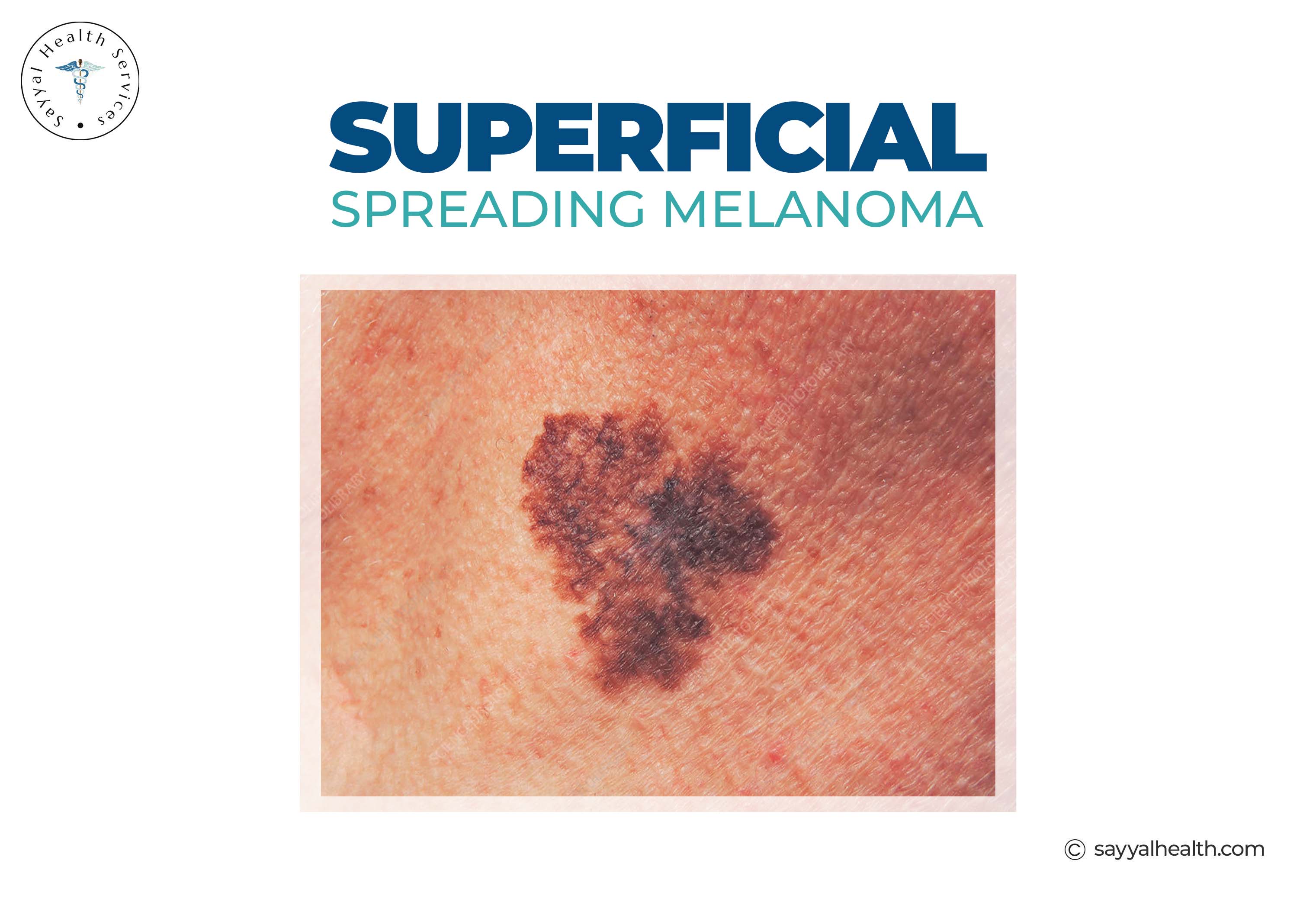 Superficial spreading melanoma skin cancer example