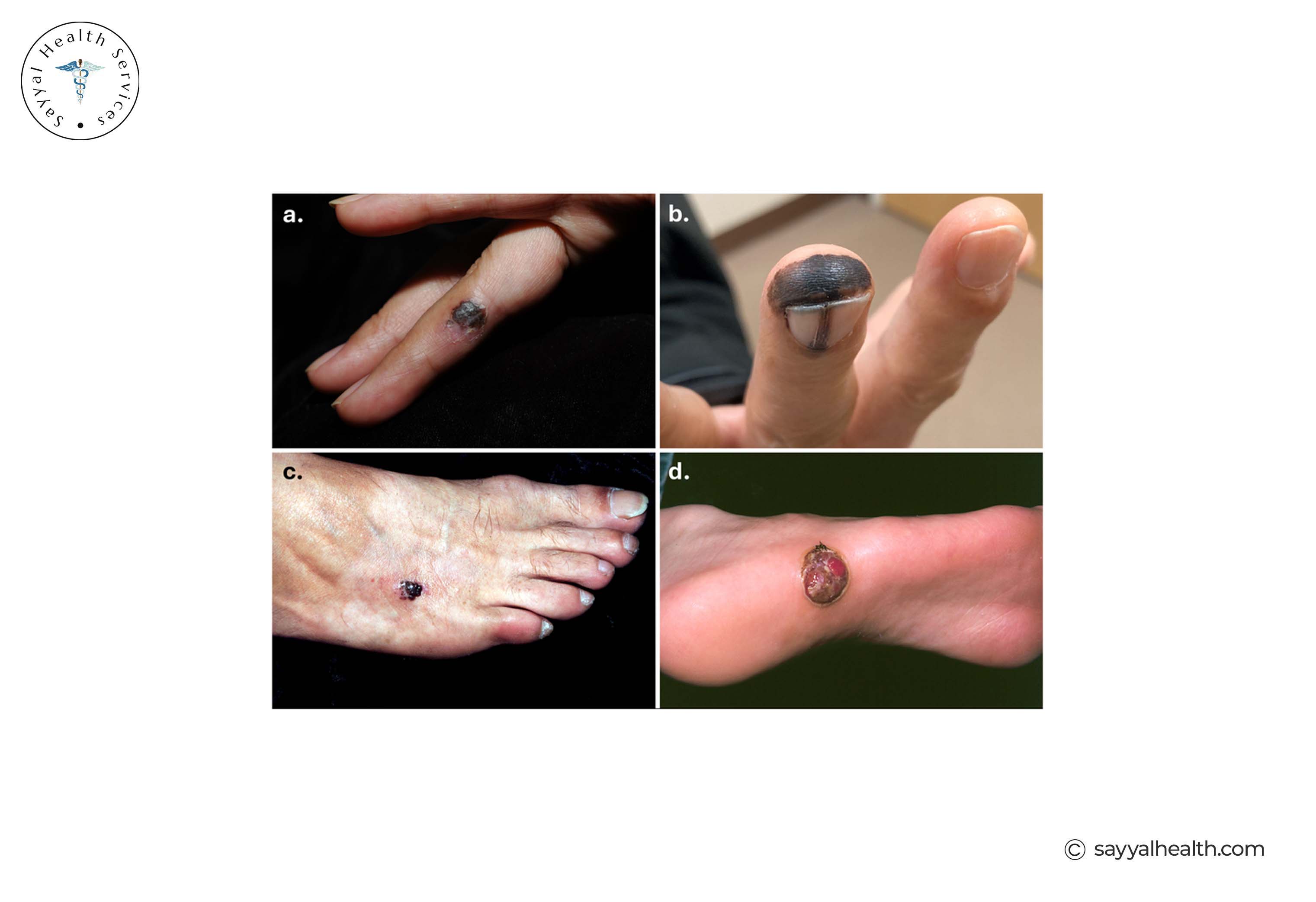 Acral Lentiginous Melanoma Images