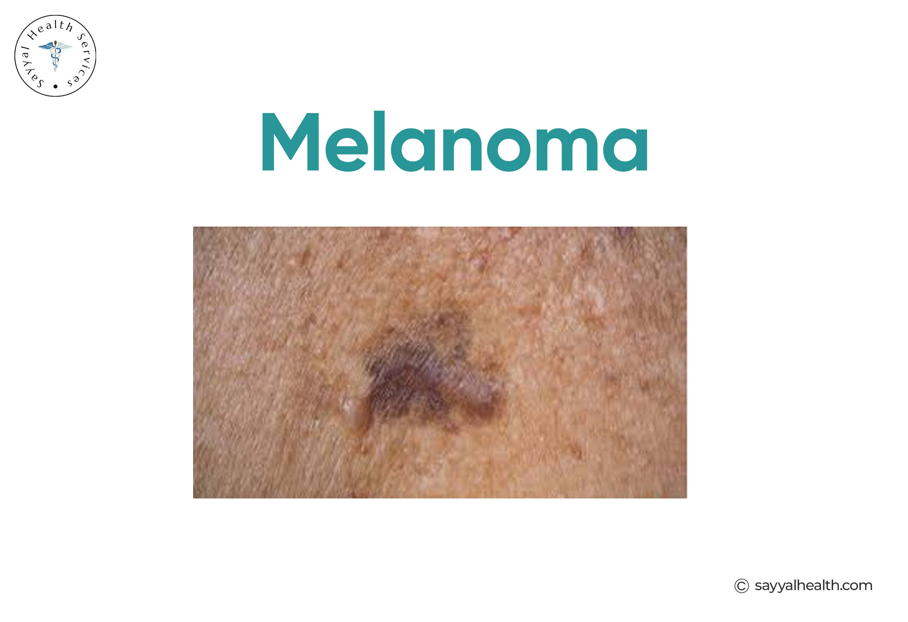 Melanoma