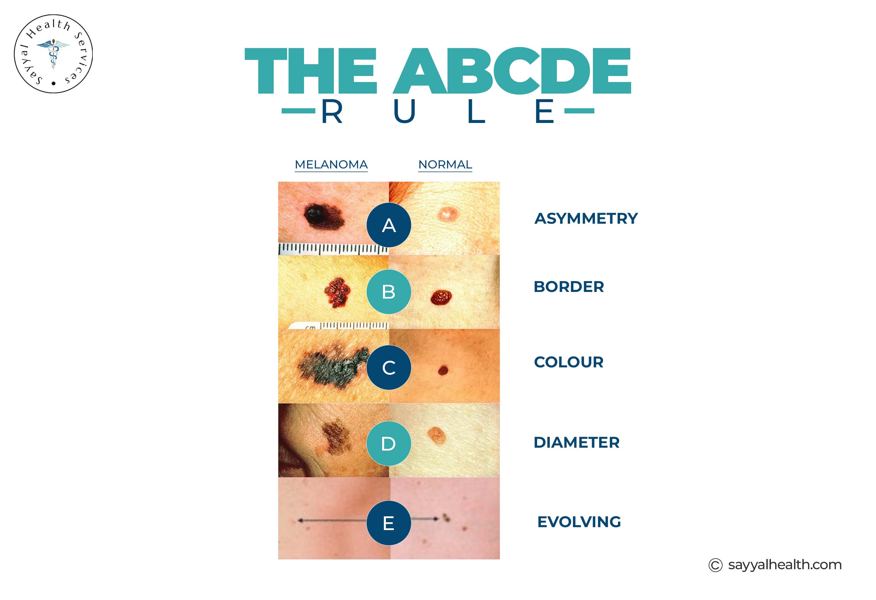 ABCDE melanoma detection rule infographic