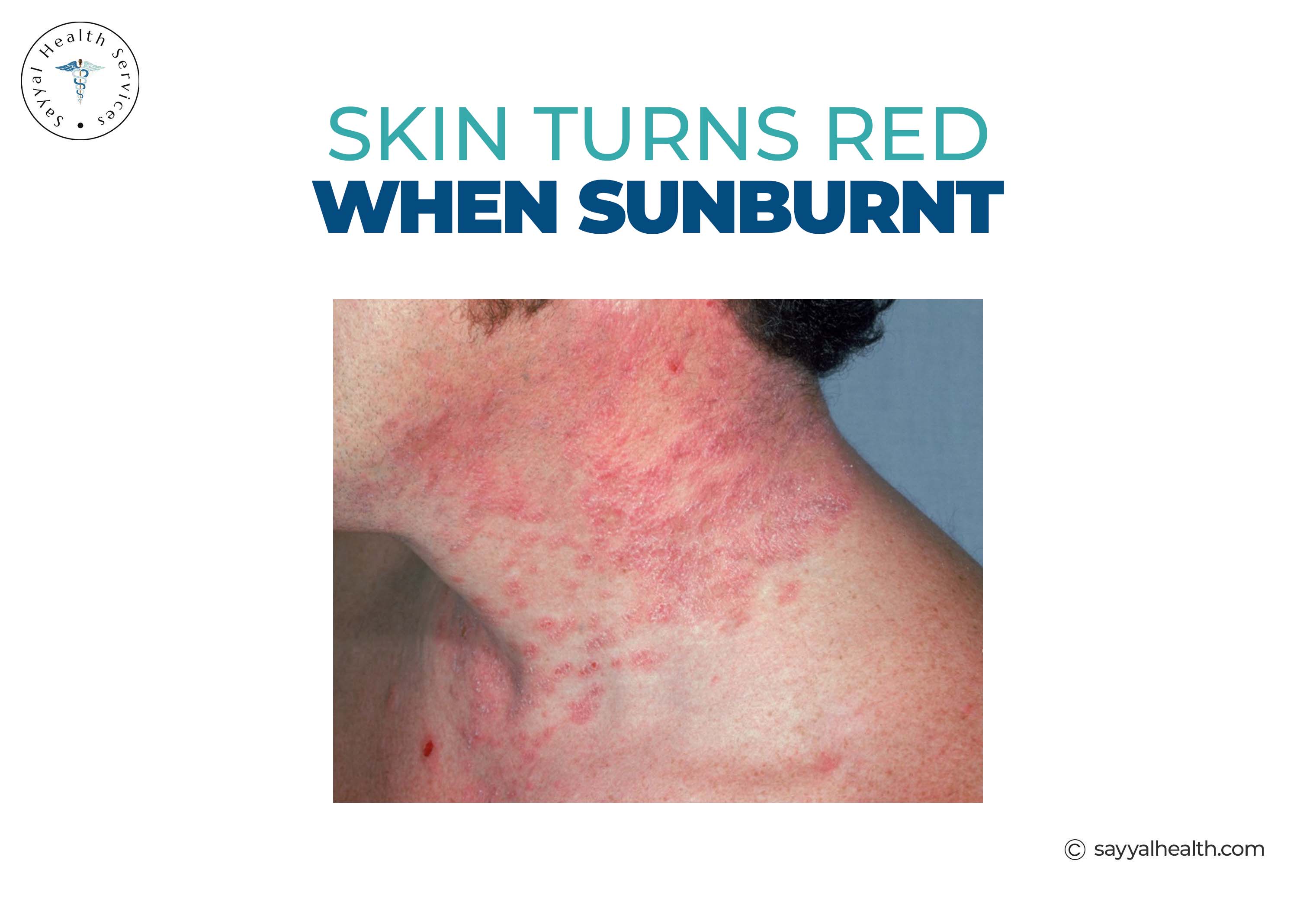 Skin Turns Red when Sunburnt