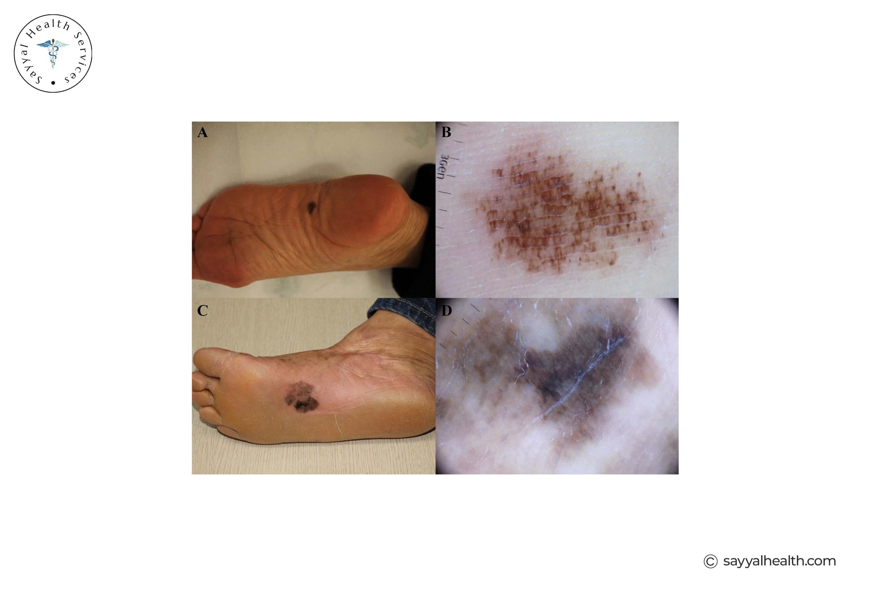 Acral Lentiginous Melanoma Images
