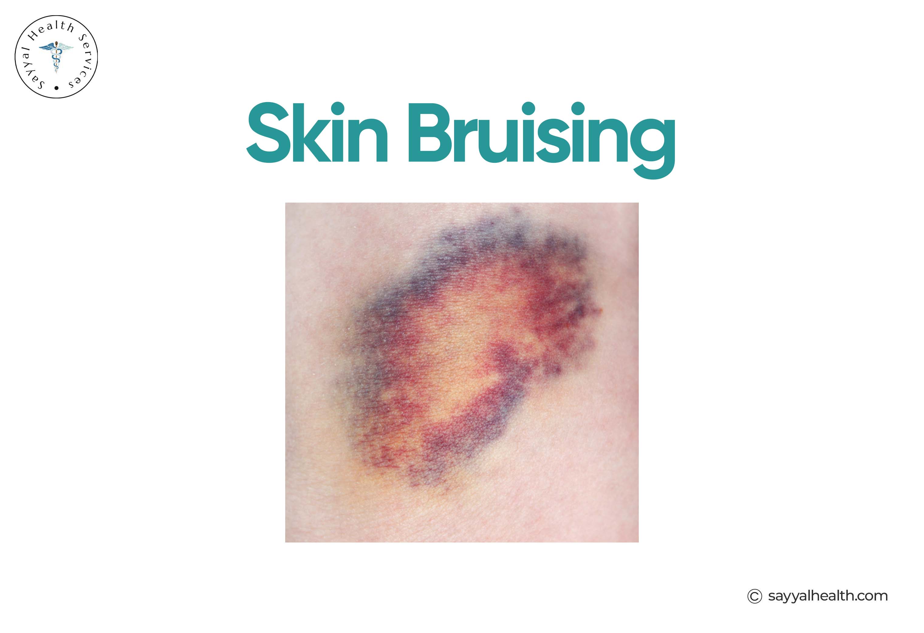 Skin Bruising