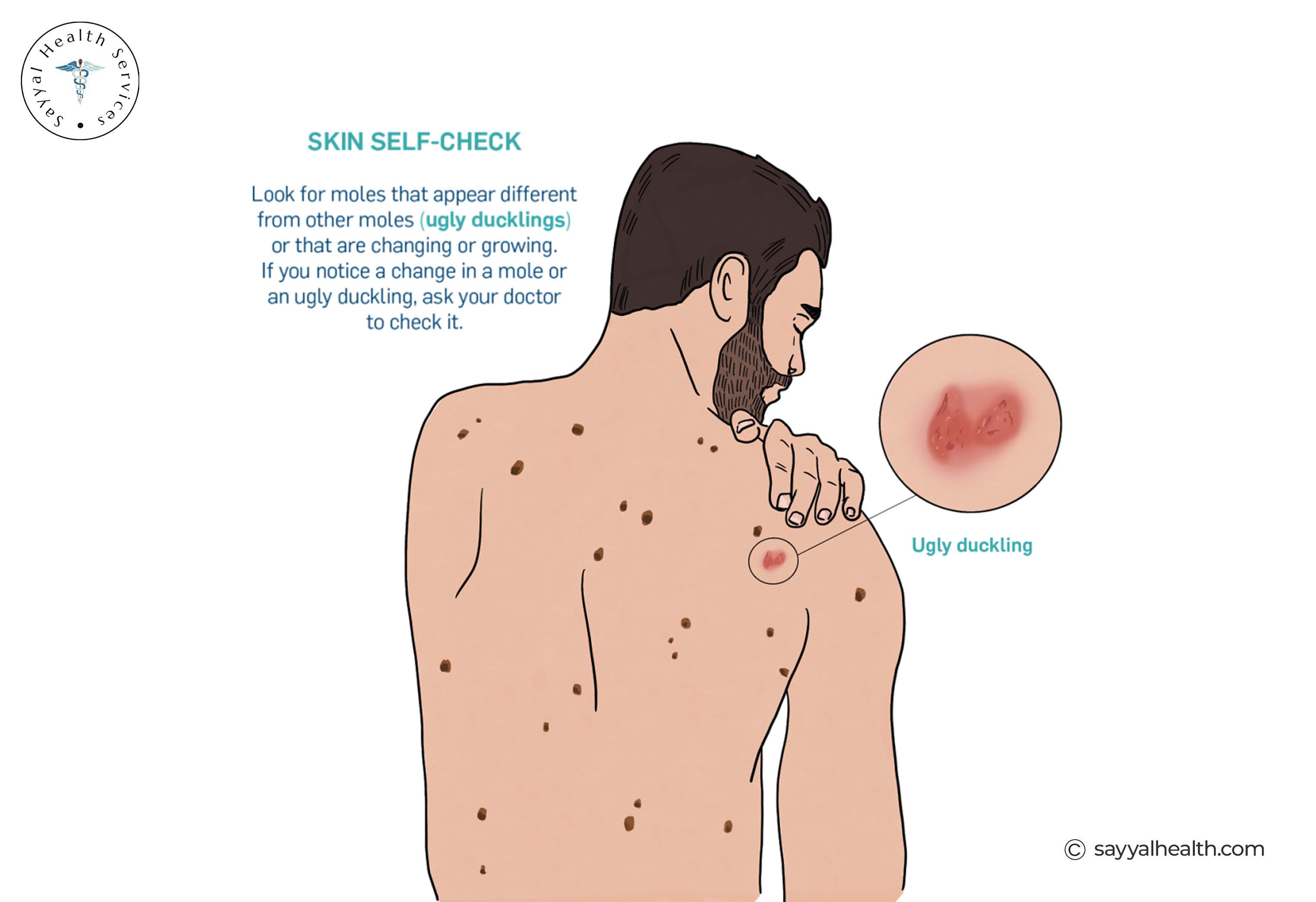 Skin self-check ugly duckling mole warning sign