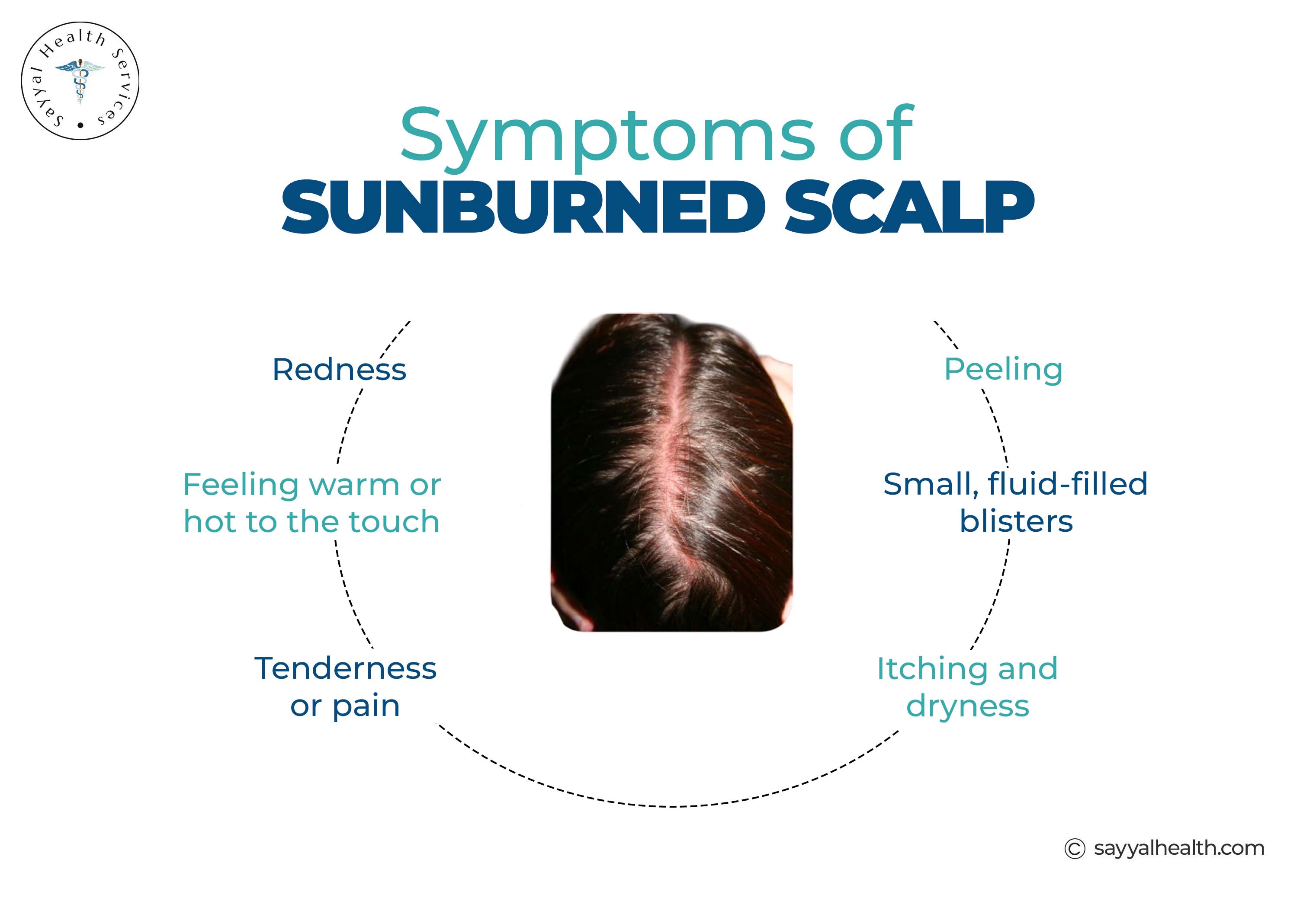 Symptoms of Sunburn Scalp