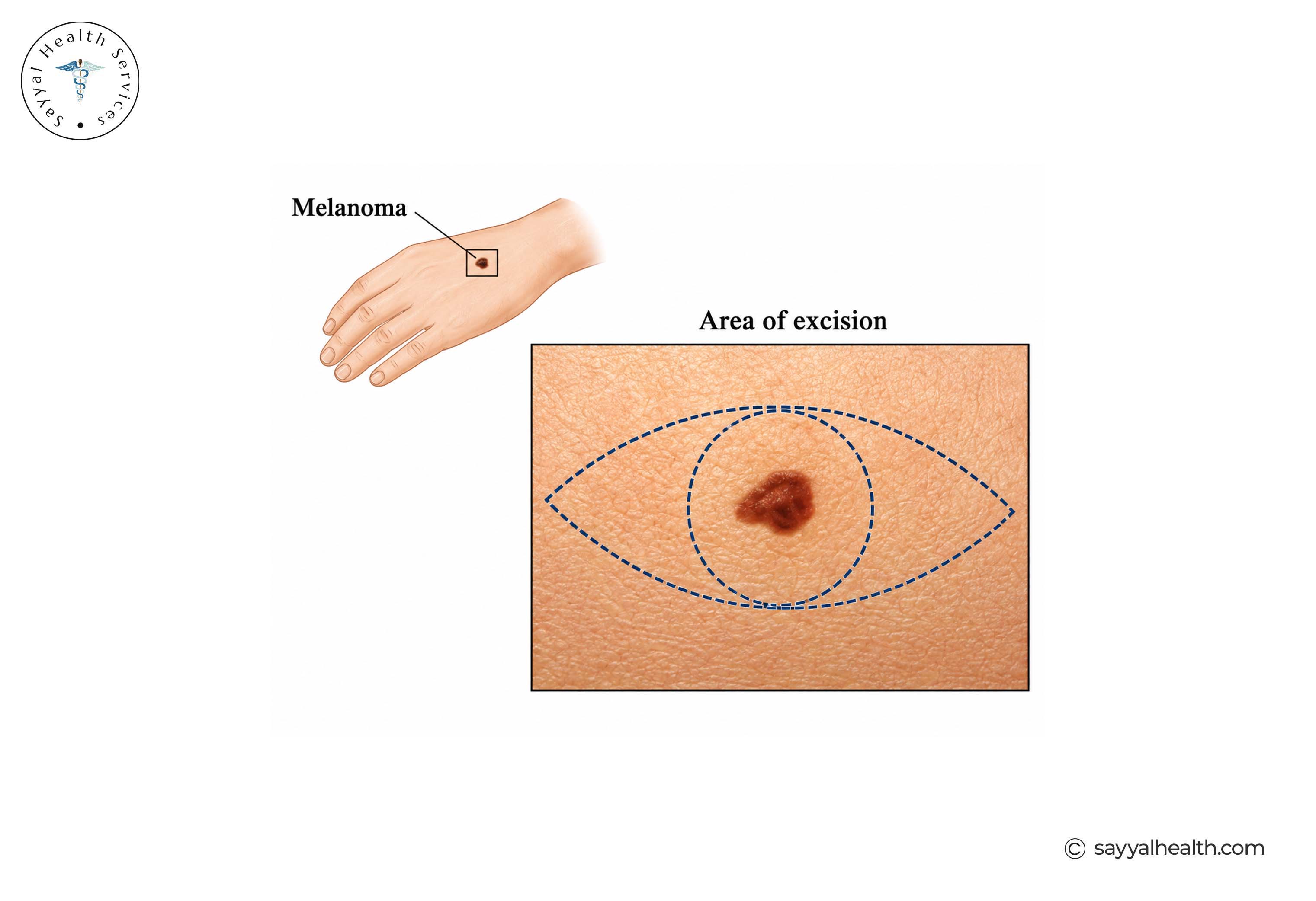 melanoma and area of excision