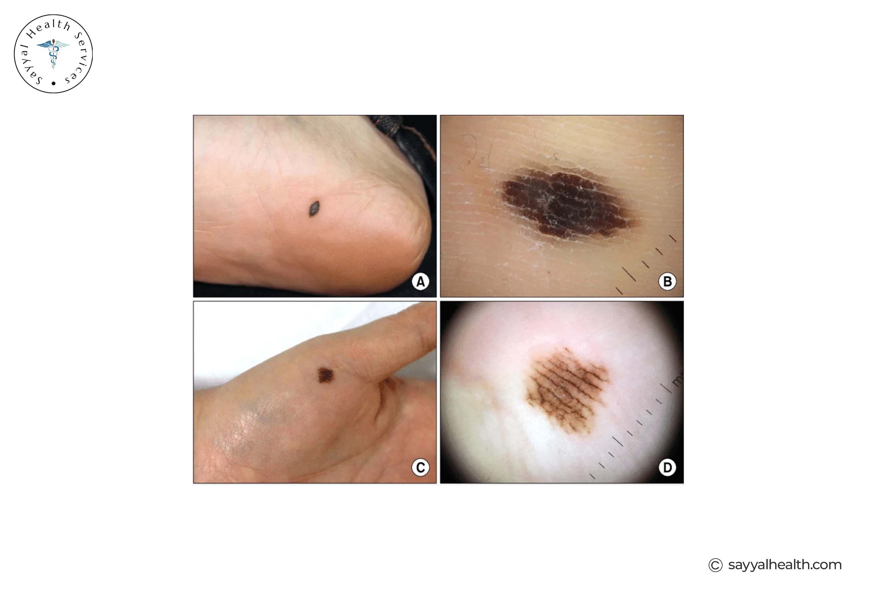 Acral Lentiginous Melanoma Images