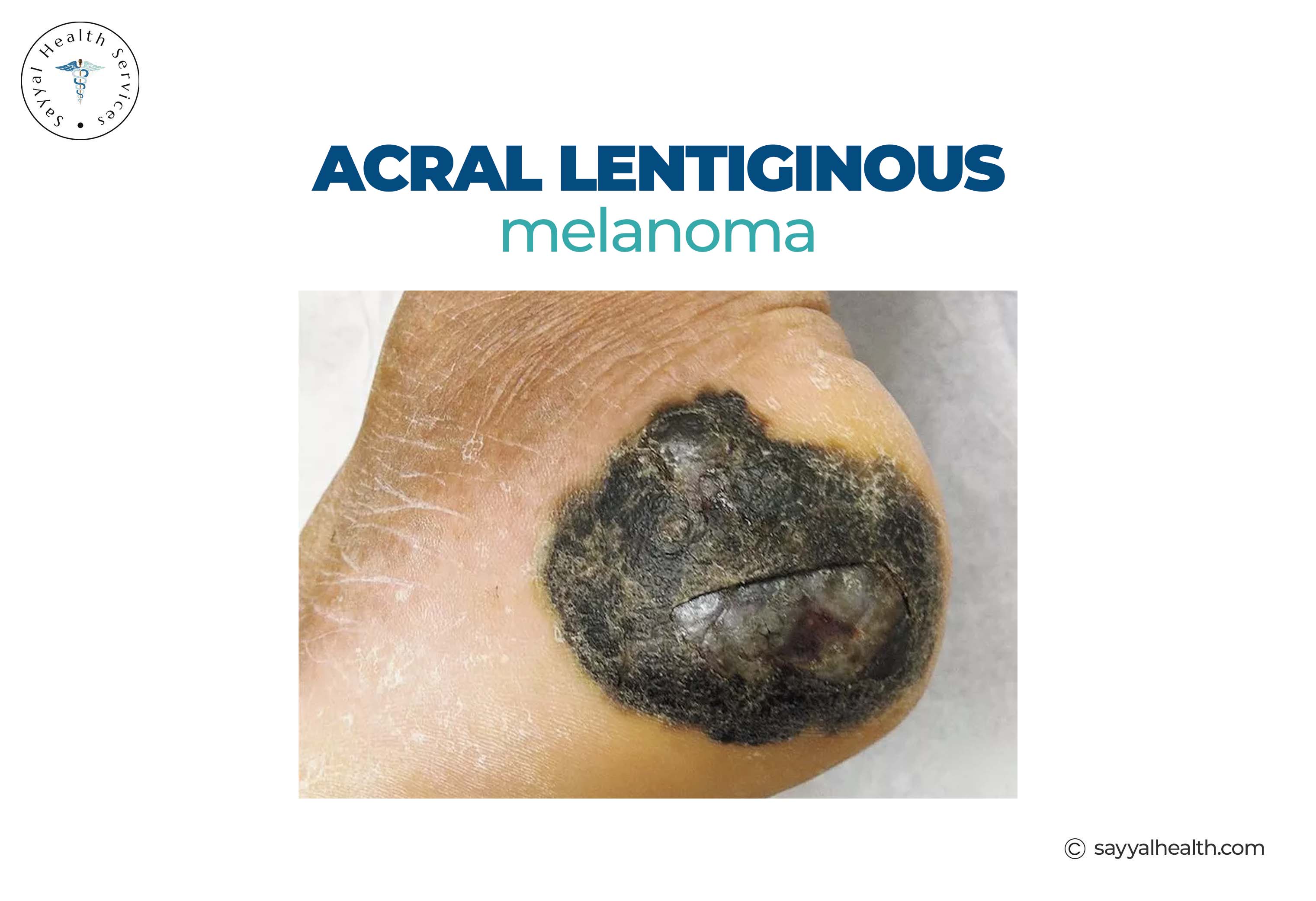 Acral lentiginous melanoma on foot sole