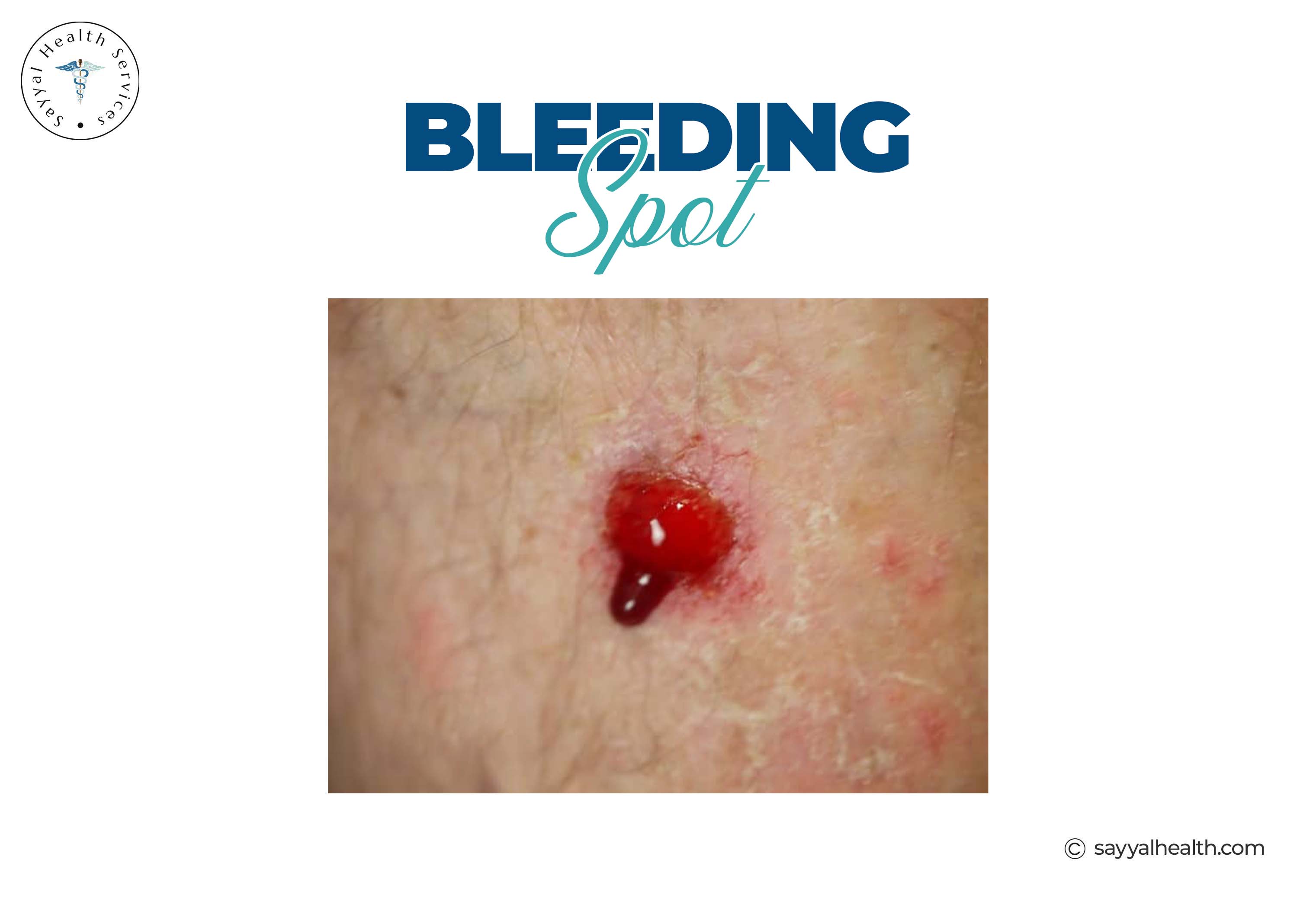 Bleeding skin spot skin cancer warning sign