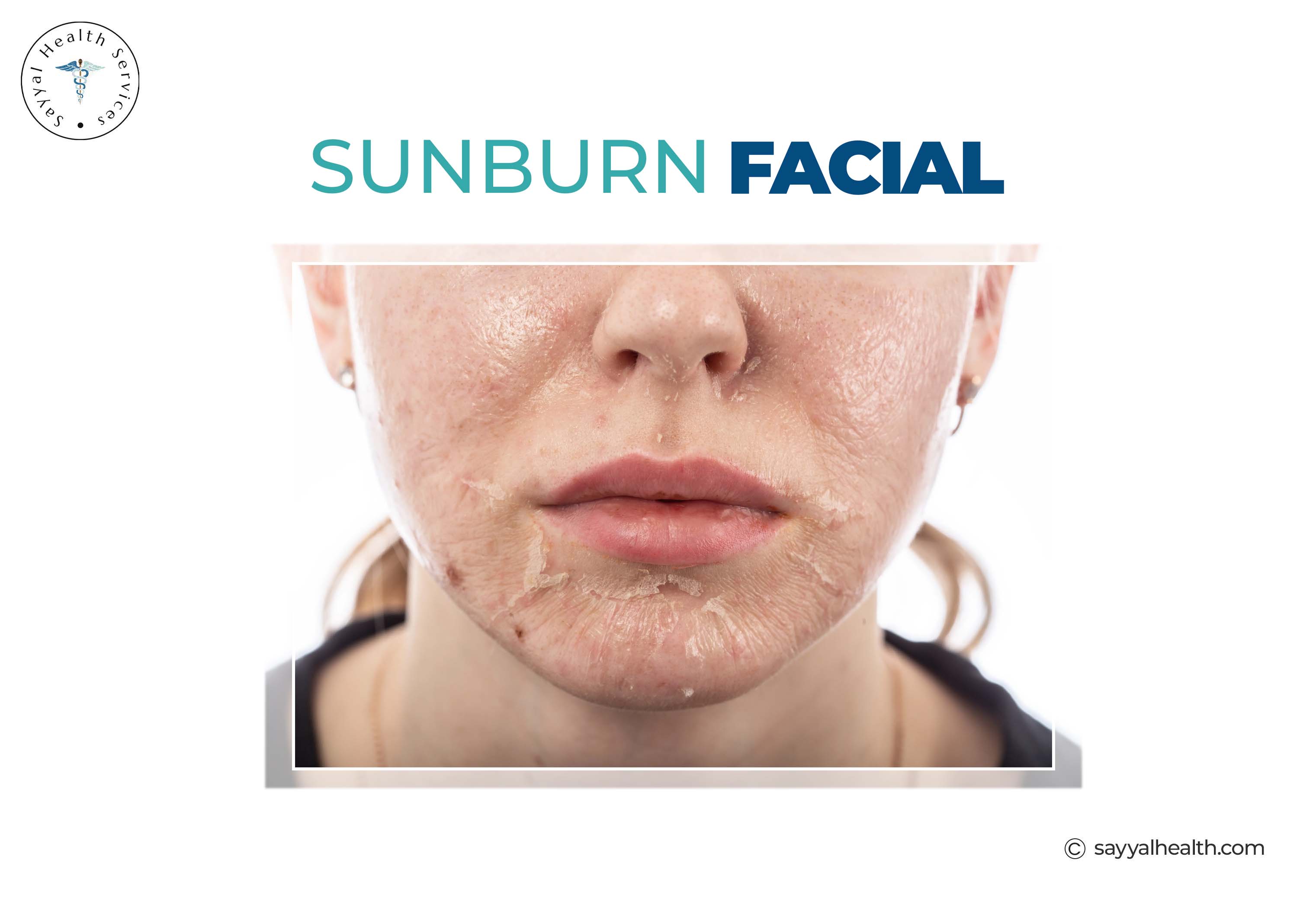 Sunburn Facial