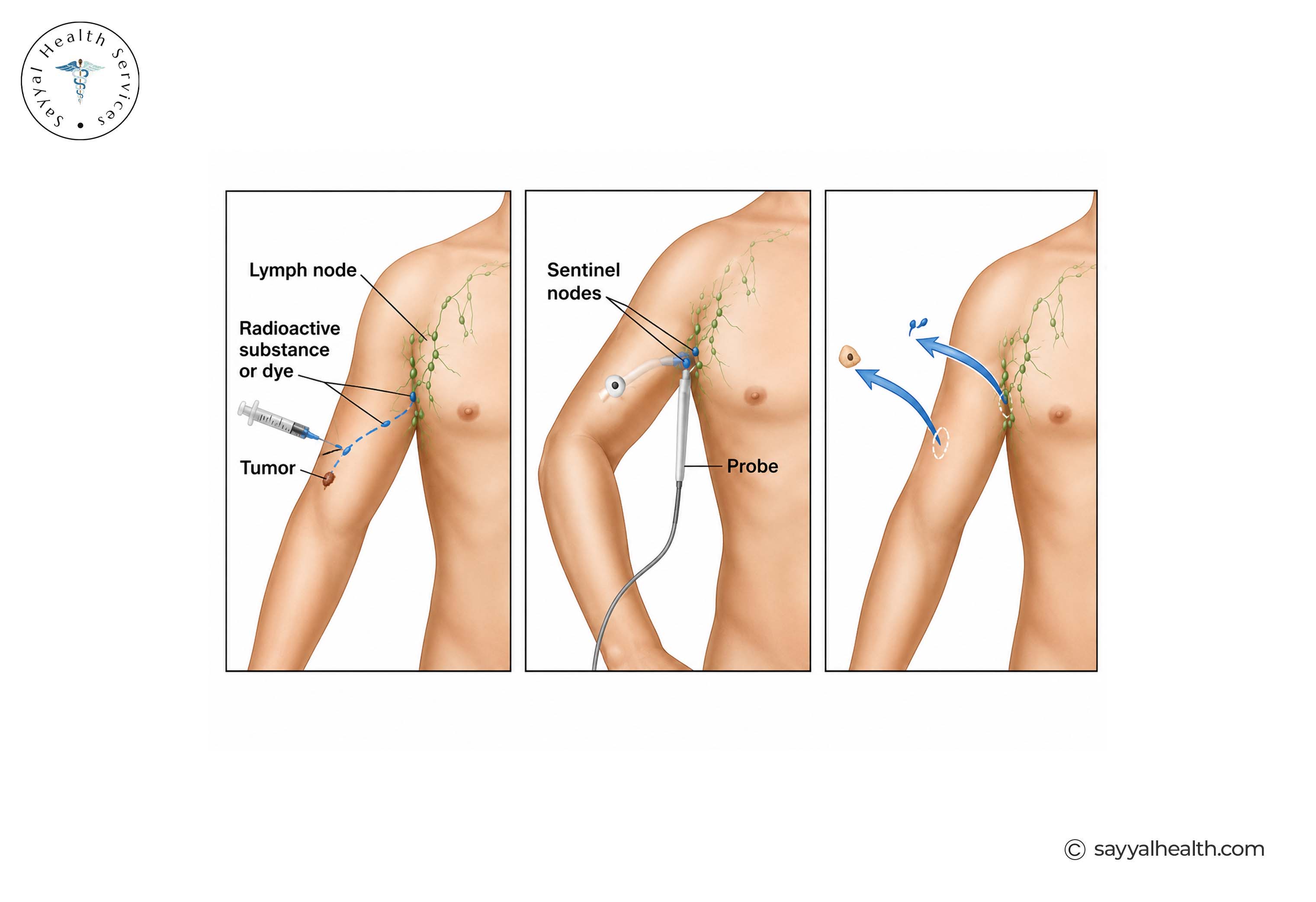 Melanoma and Sentinel Lymph Node Biopsy