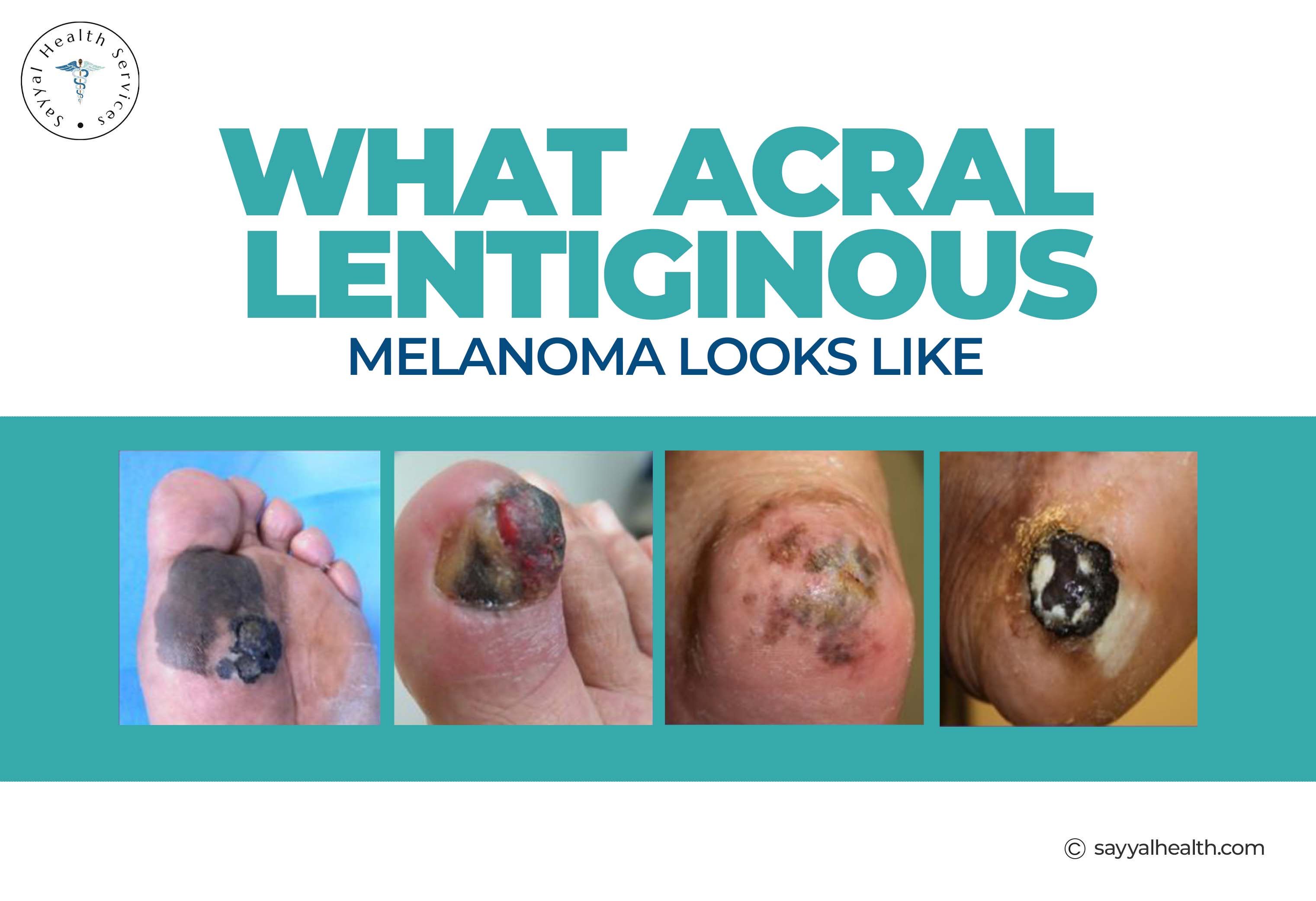 what Acral Lentiginous Melanoma looks like