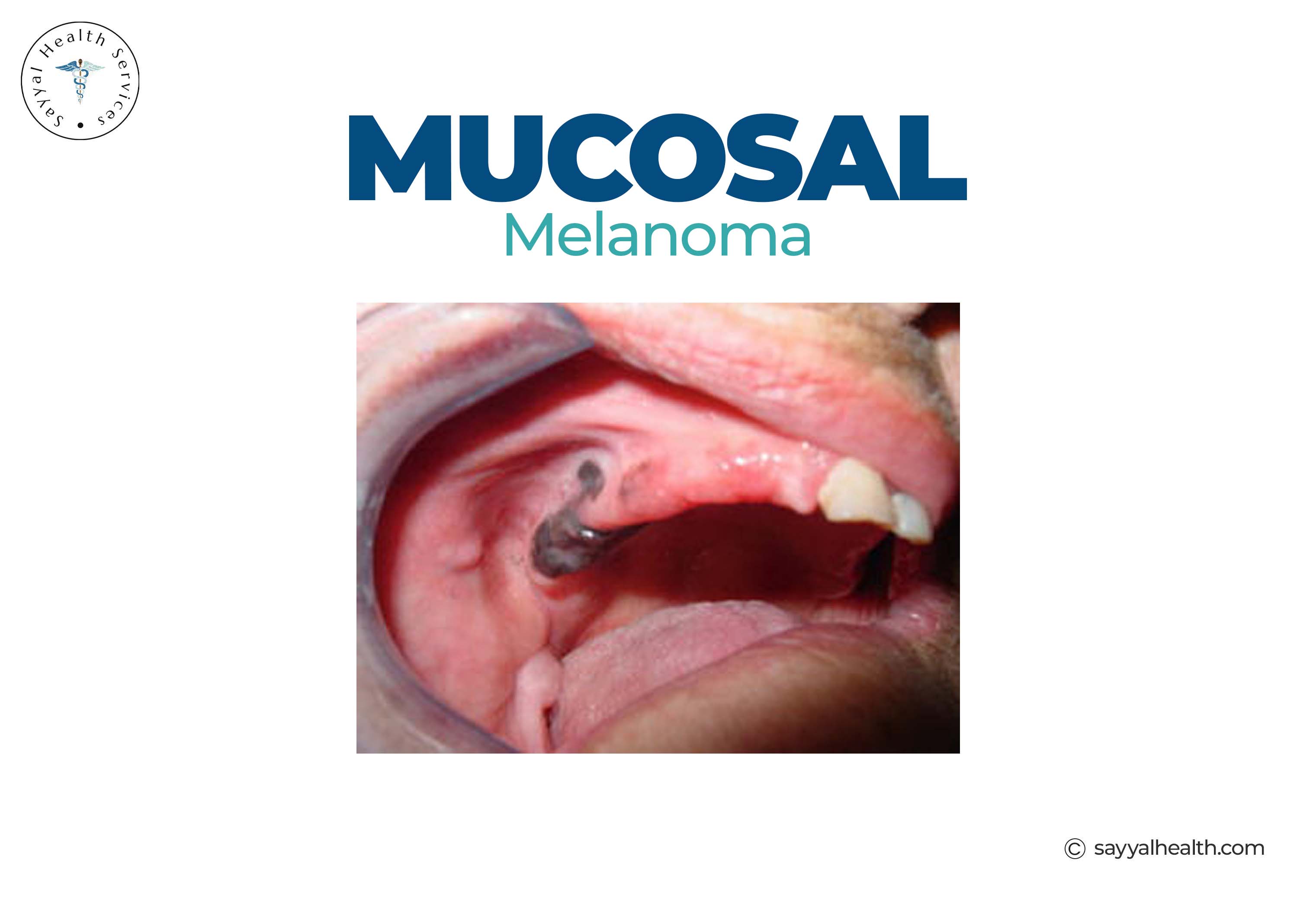 Mucosal melanoma inside mouth oral cavity