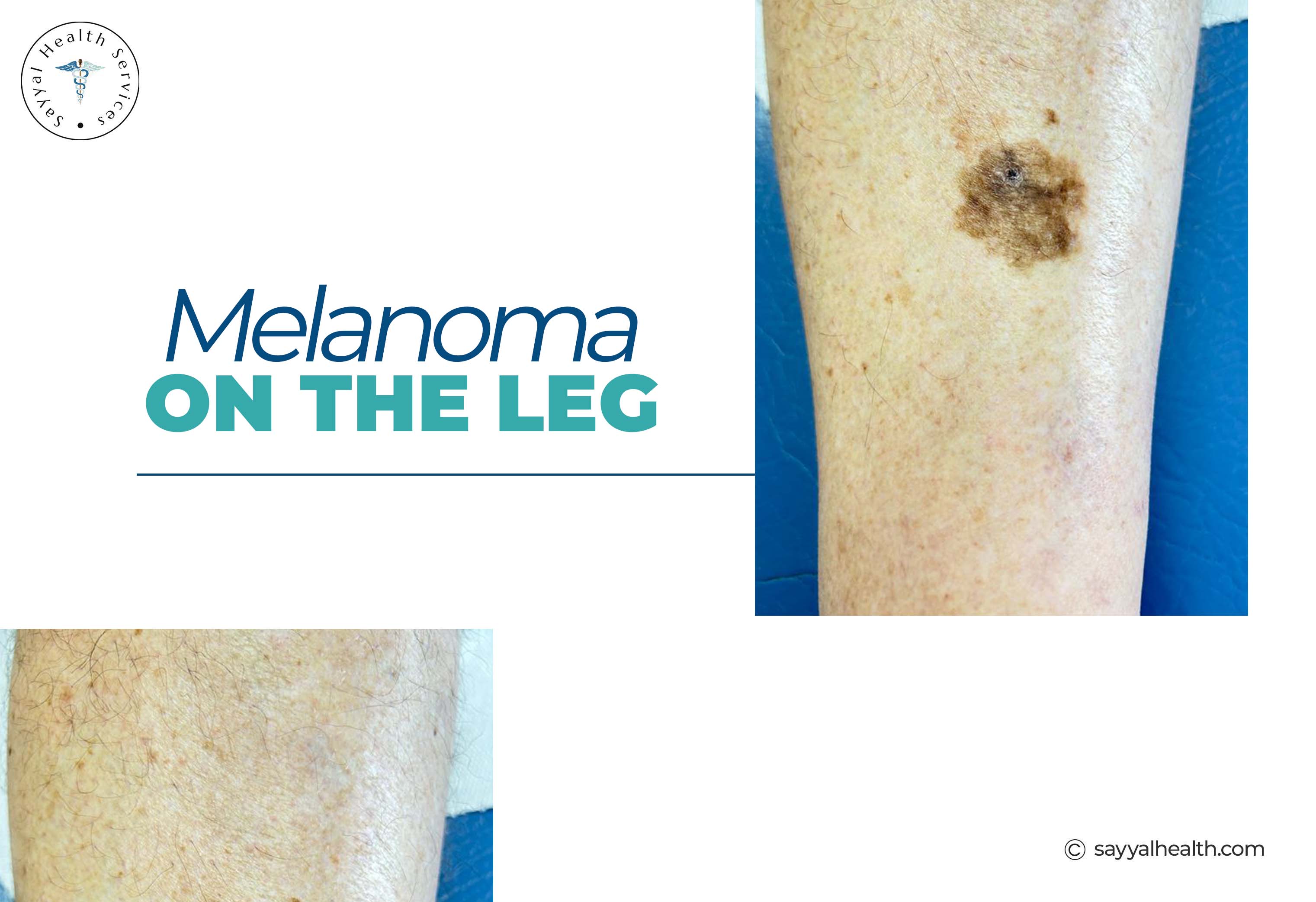 Melanoma skin cancer lesion on leg