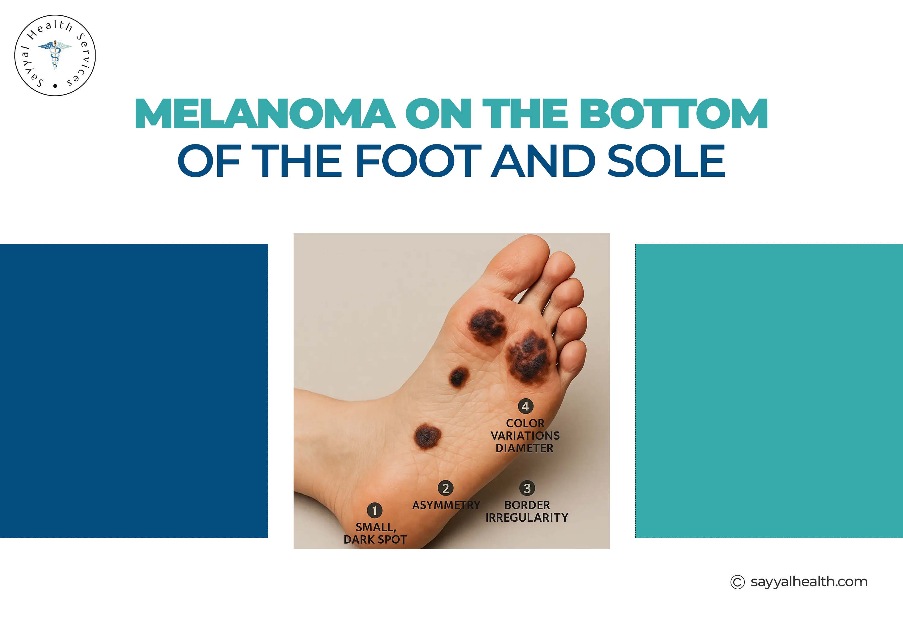 melanoma on bottom of foot sole