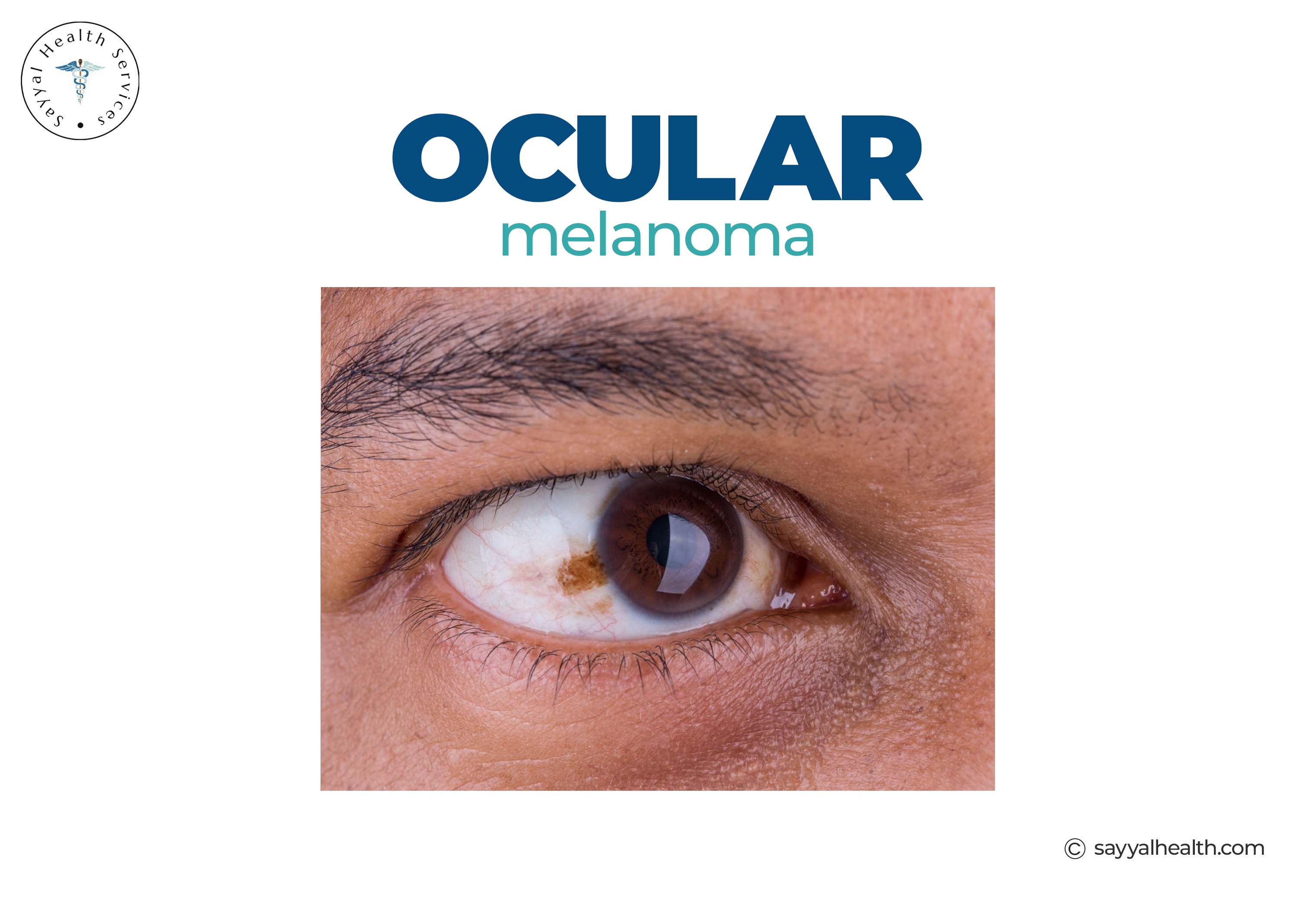 Ocular melanoma dark pigmentation on eye white