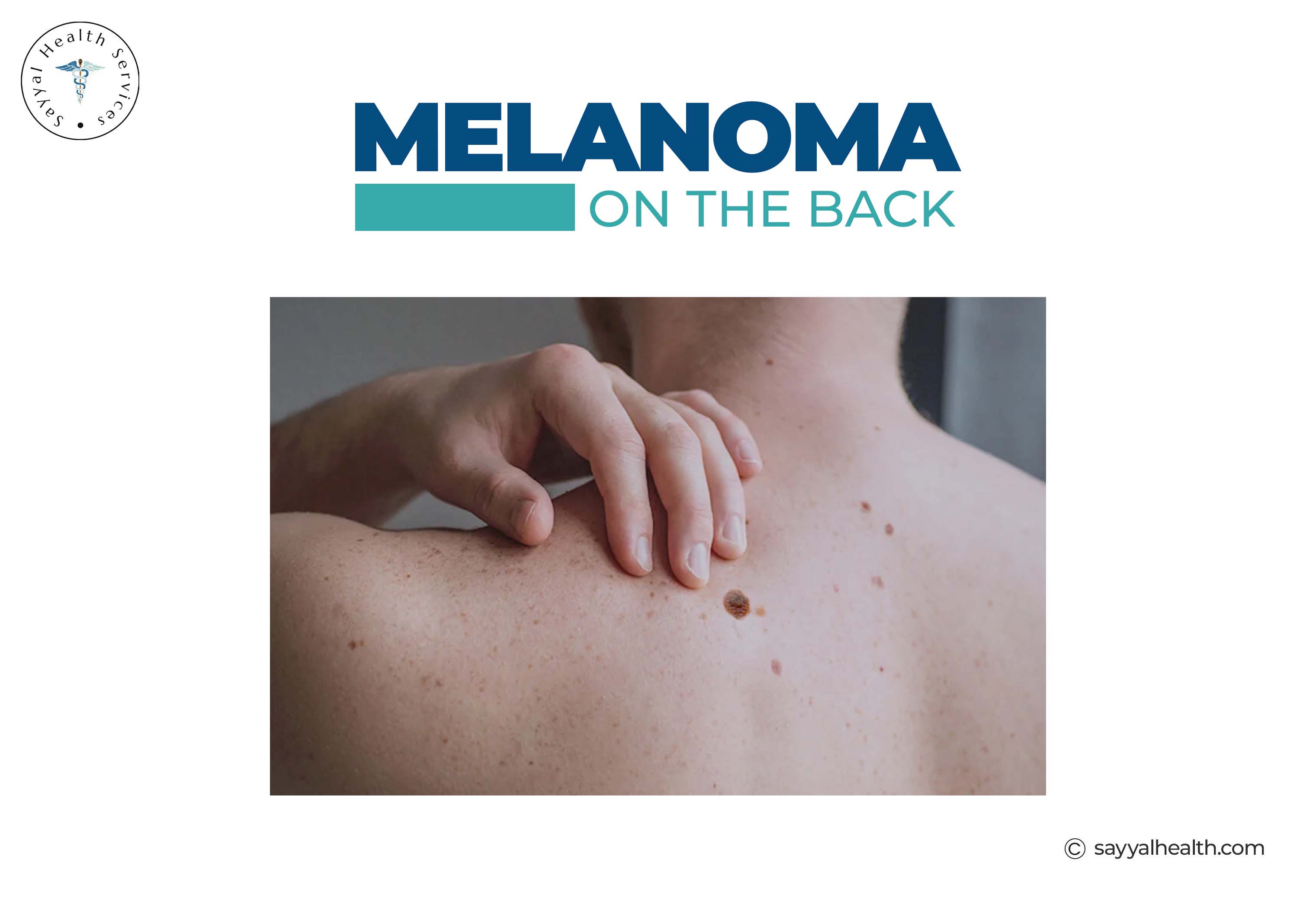 Melanoma skin cancer lesion on back