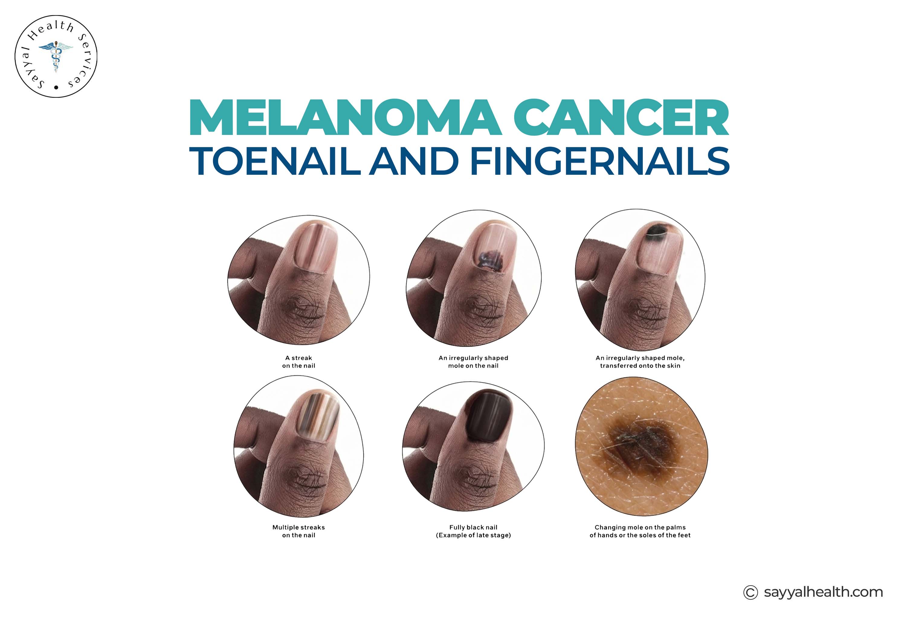 melanoma cancer toenail and fingernails