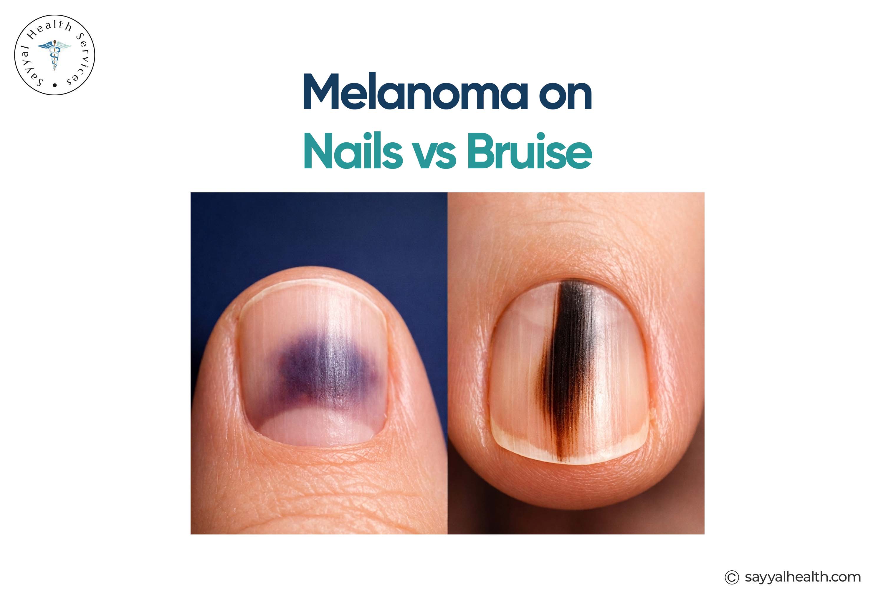 Melanoma on Nails vs Bruise