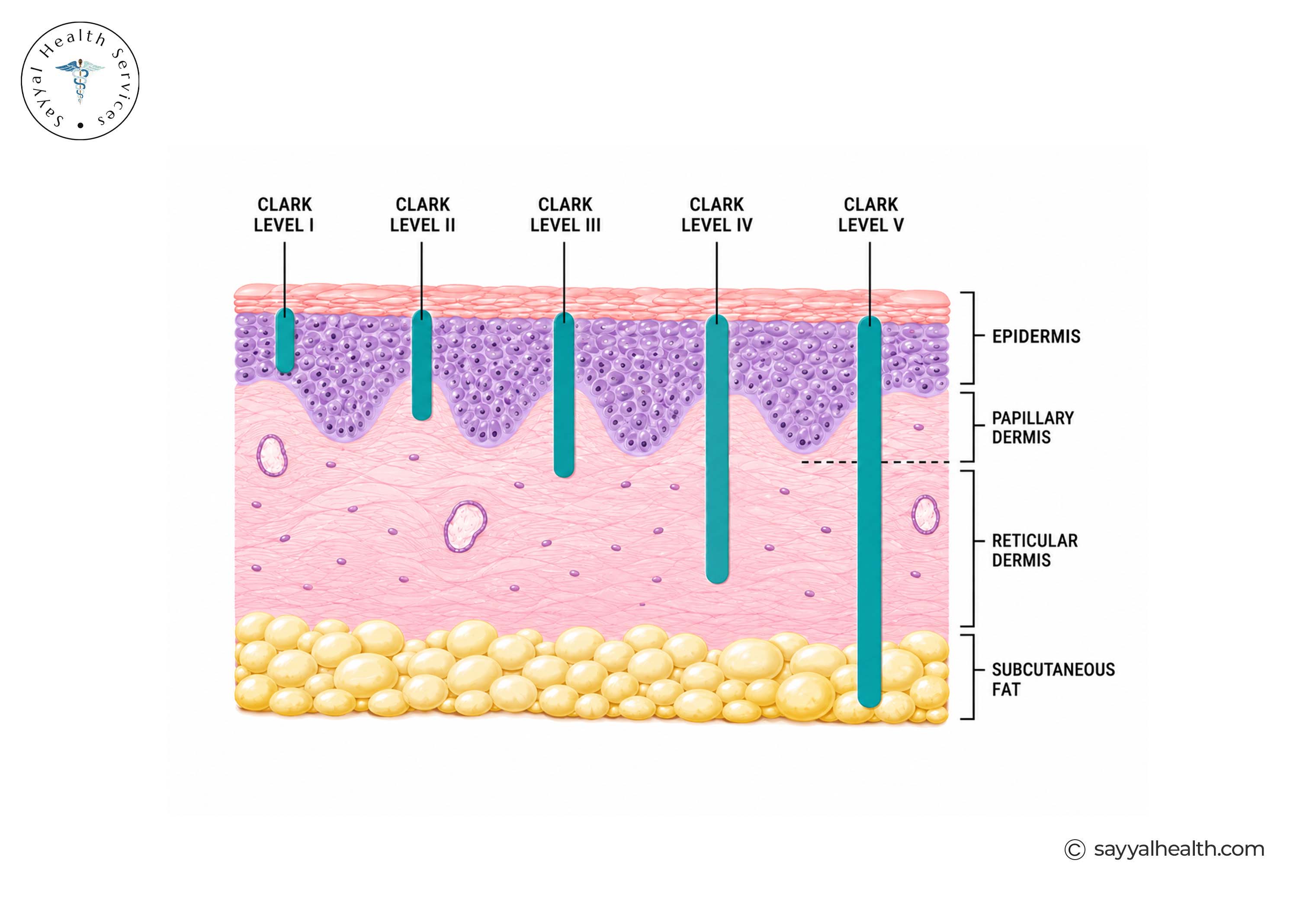 clark level 1, 2, 3 and clark level 4