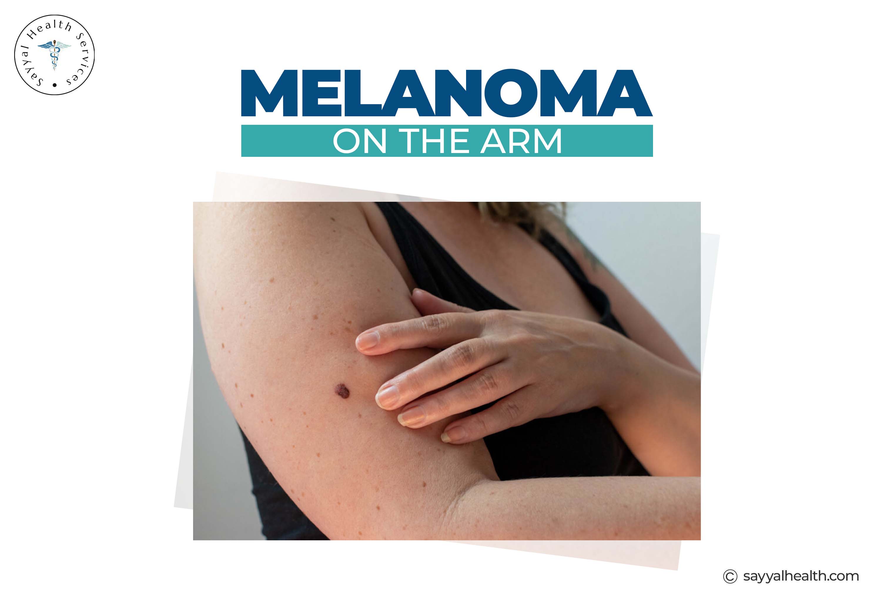 Melanoma skin cancer lesion on arm