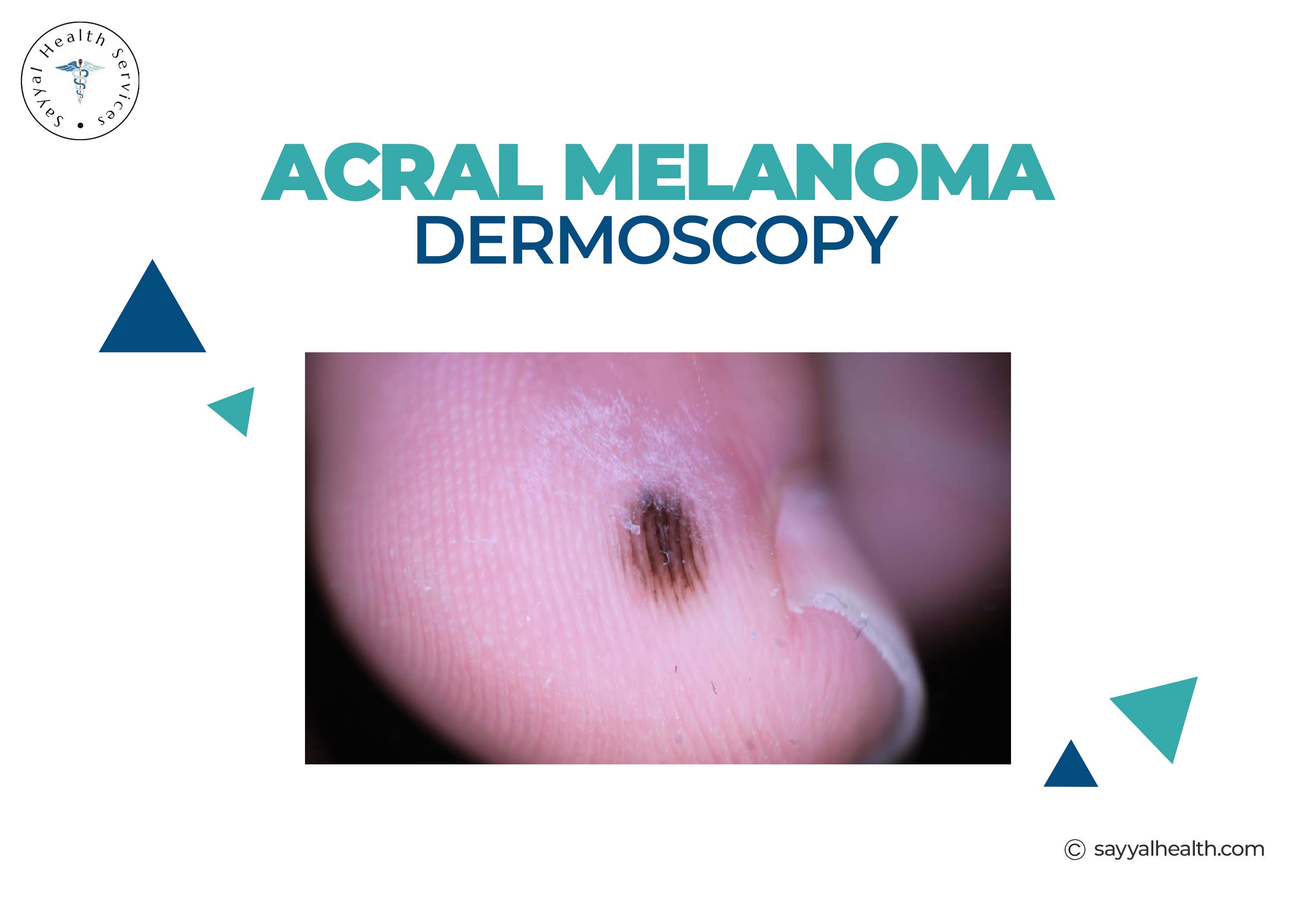 Acral Melanoma Dermoscopy