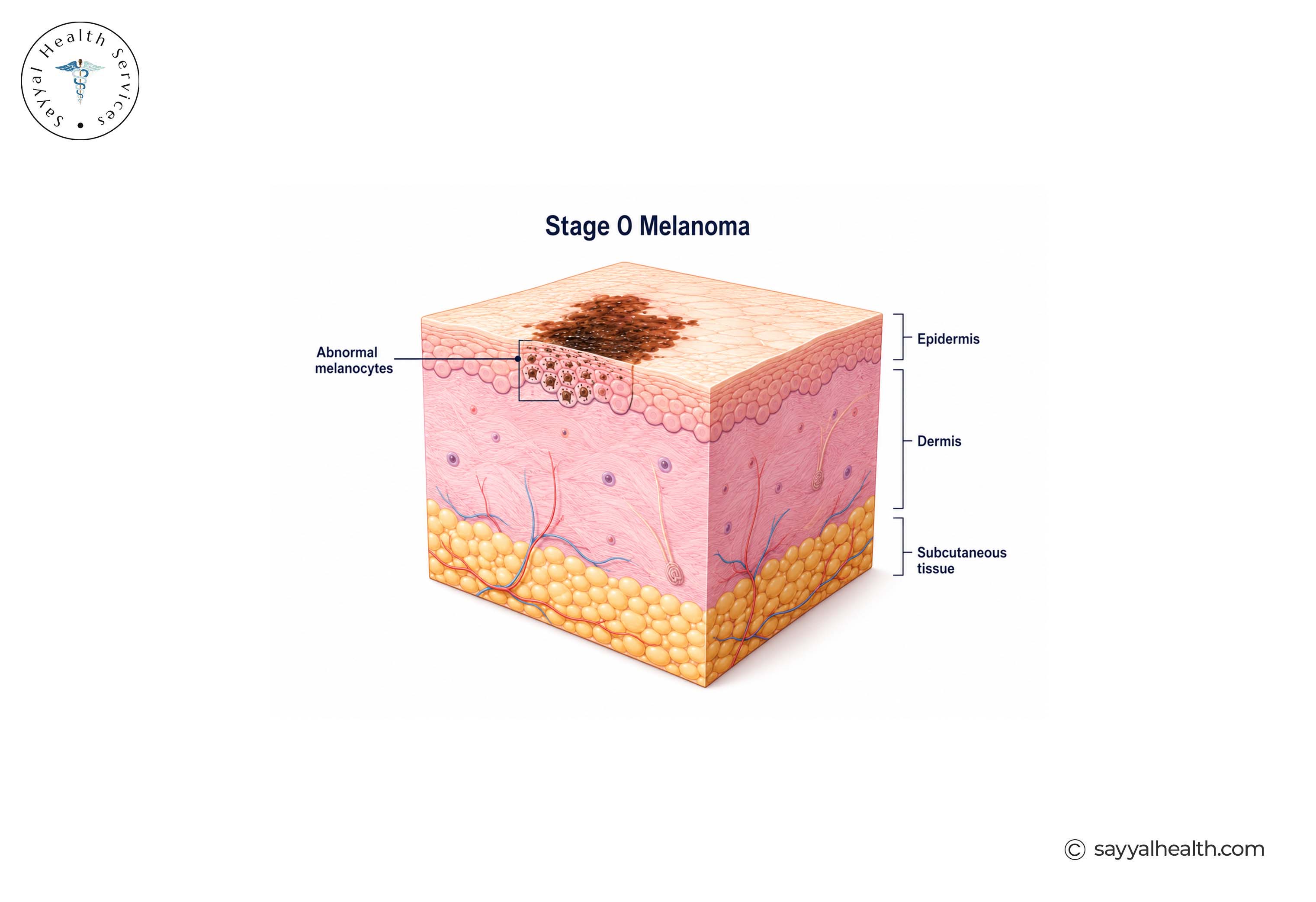 stage 0 melanoma