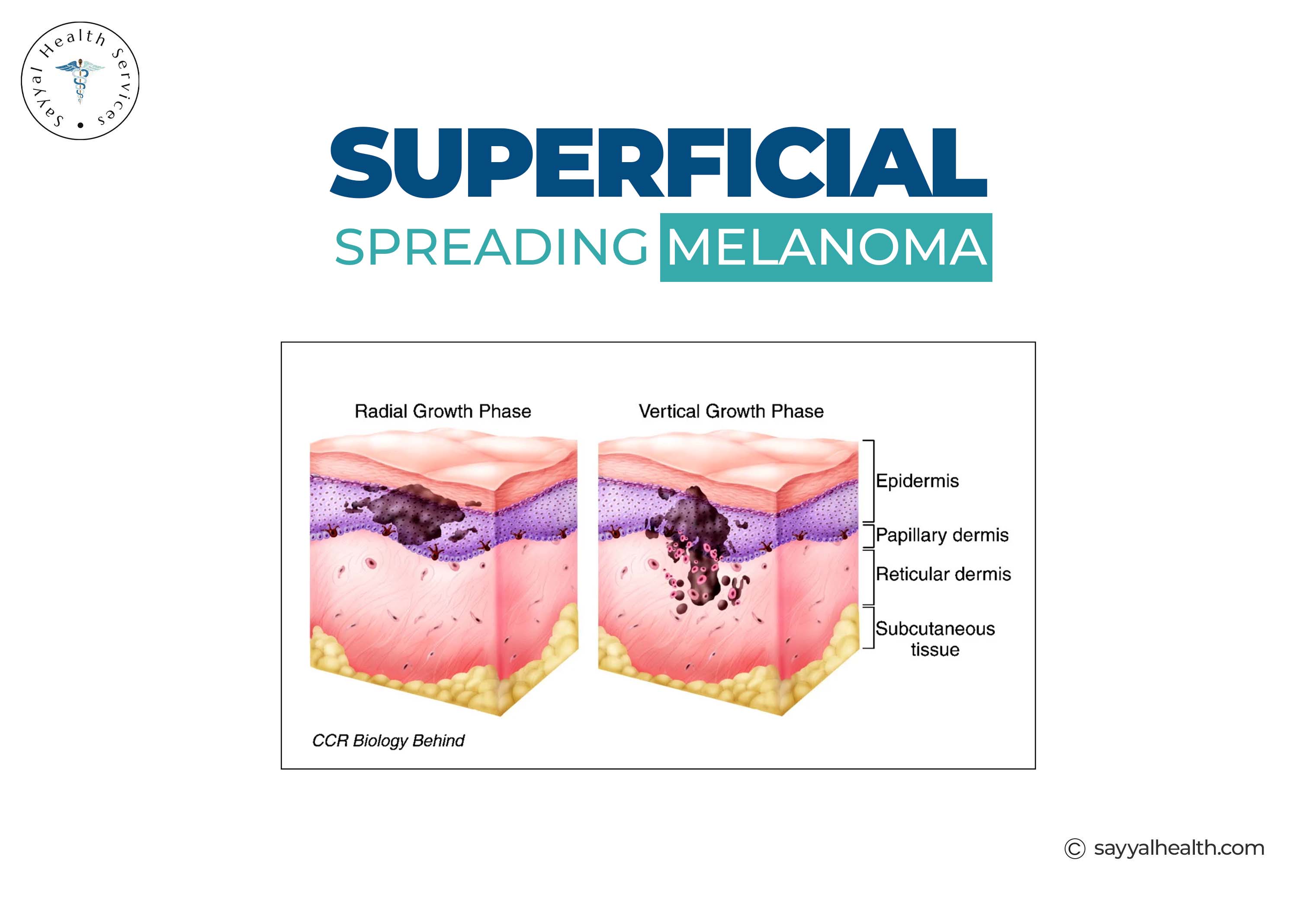 Superficial spreading melanoma radial and vertical growth phases diagram