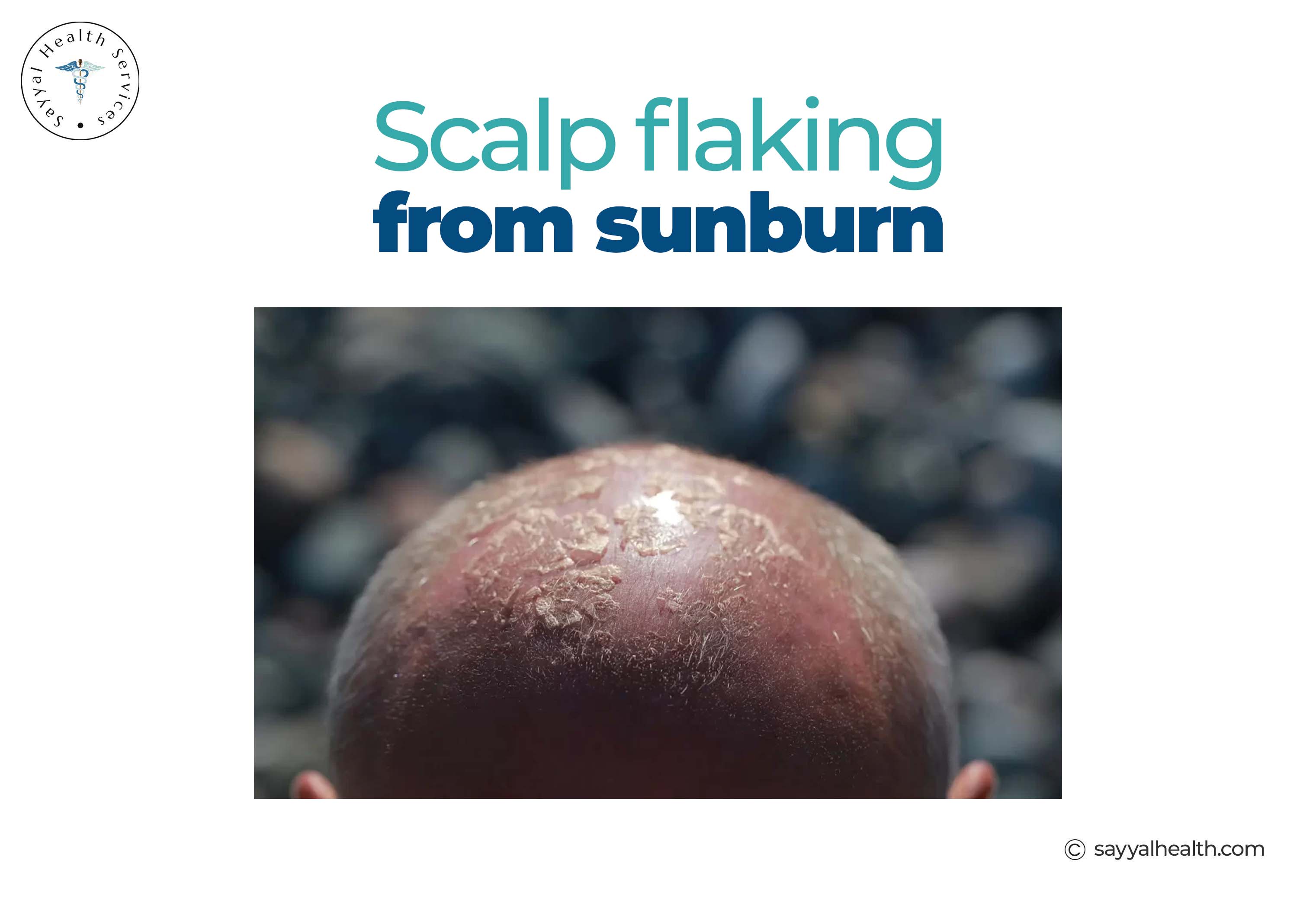 Scalp Falking from sunburn