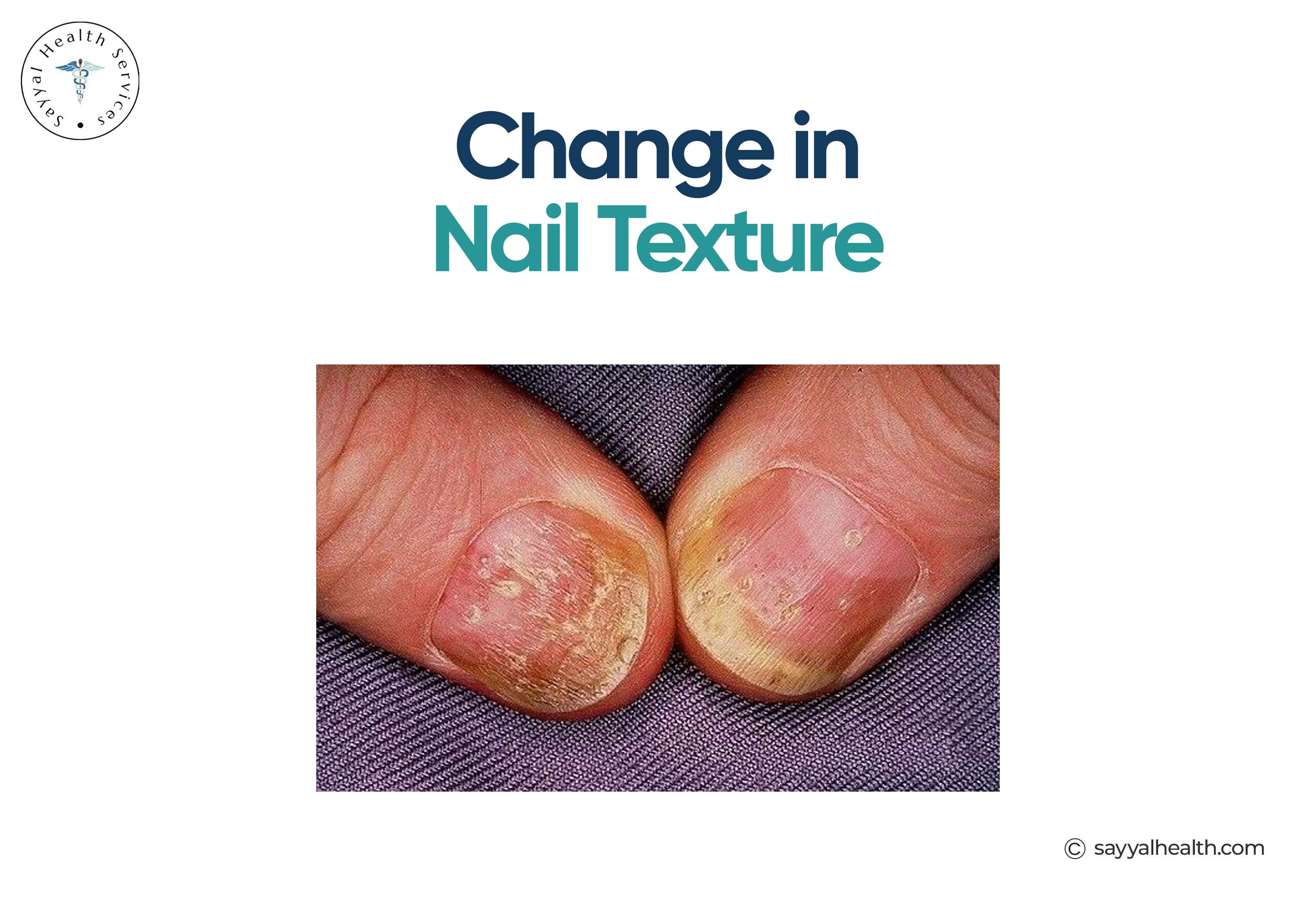 Change in Nail Texture