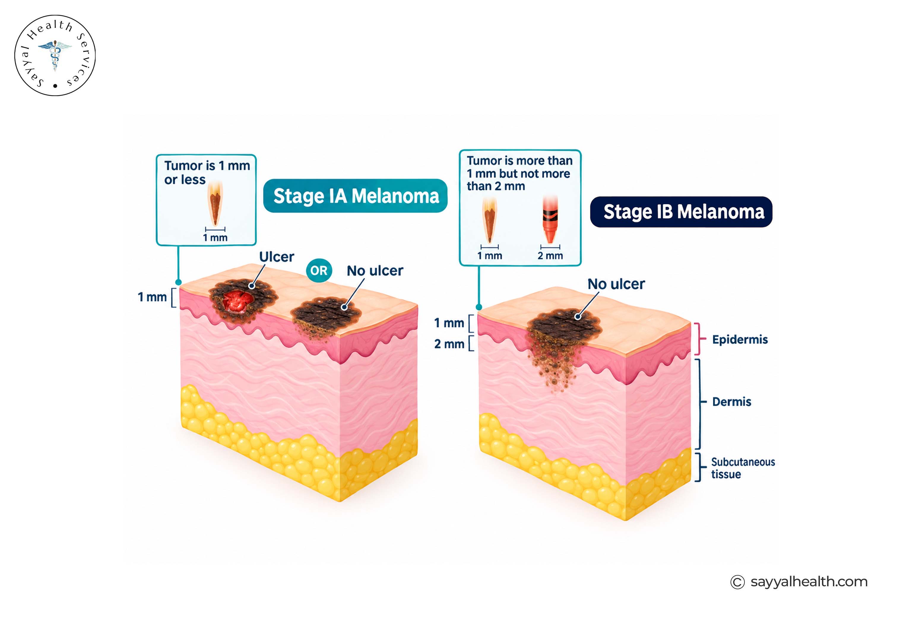 stage 1 melanoma