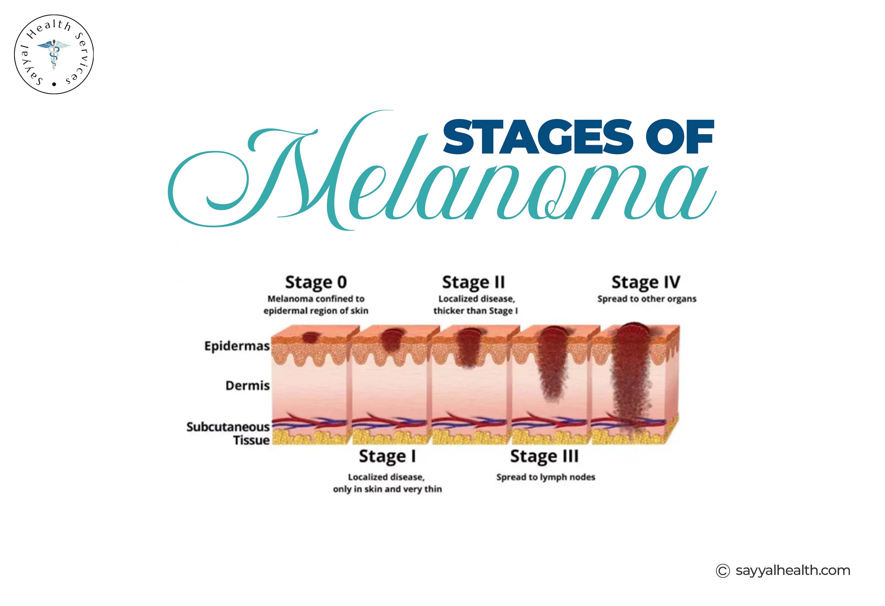 Stages of melanoma skin cancer progression infographic