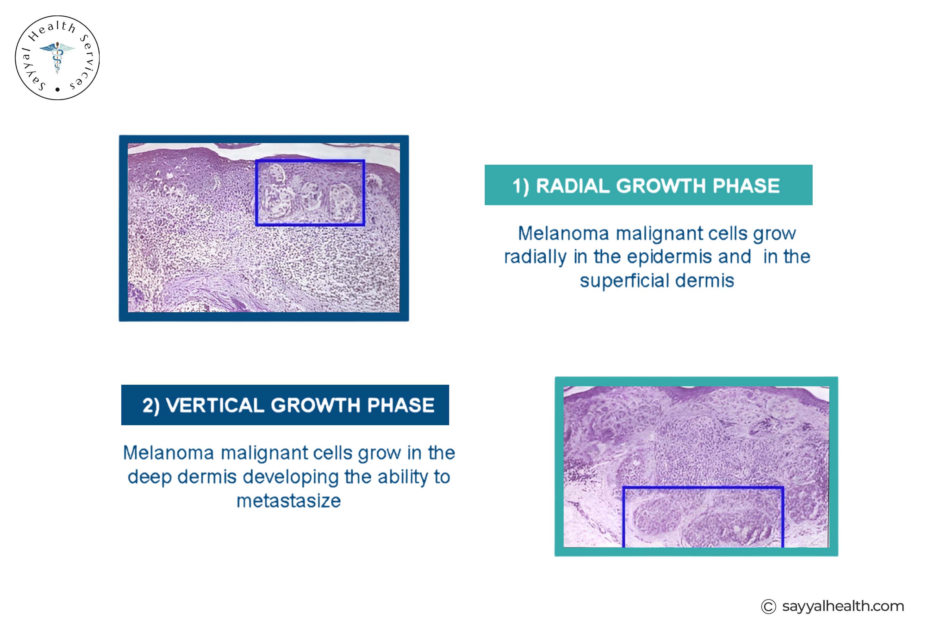 Stages of Acral Melanoma