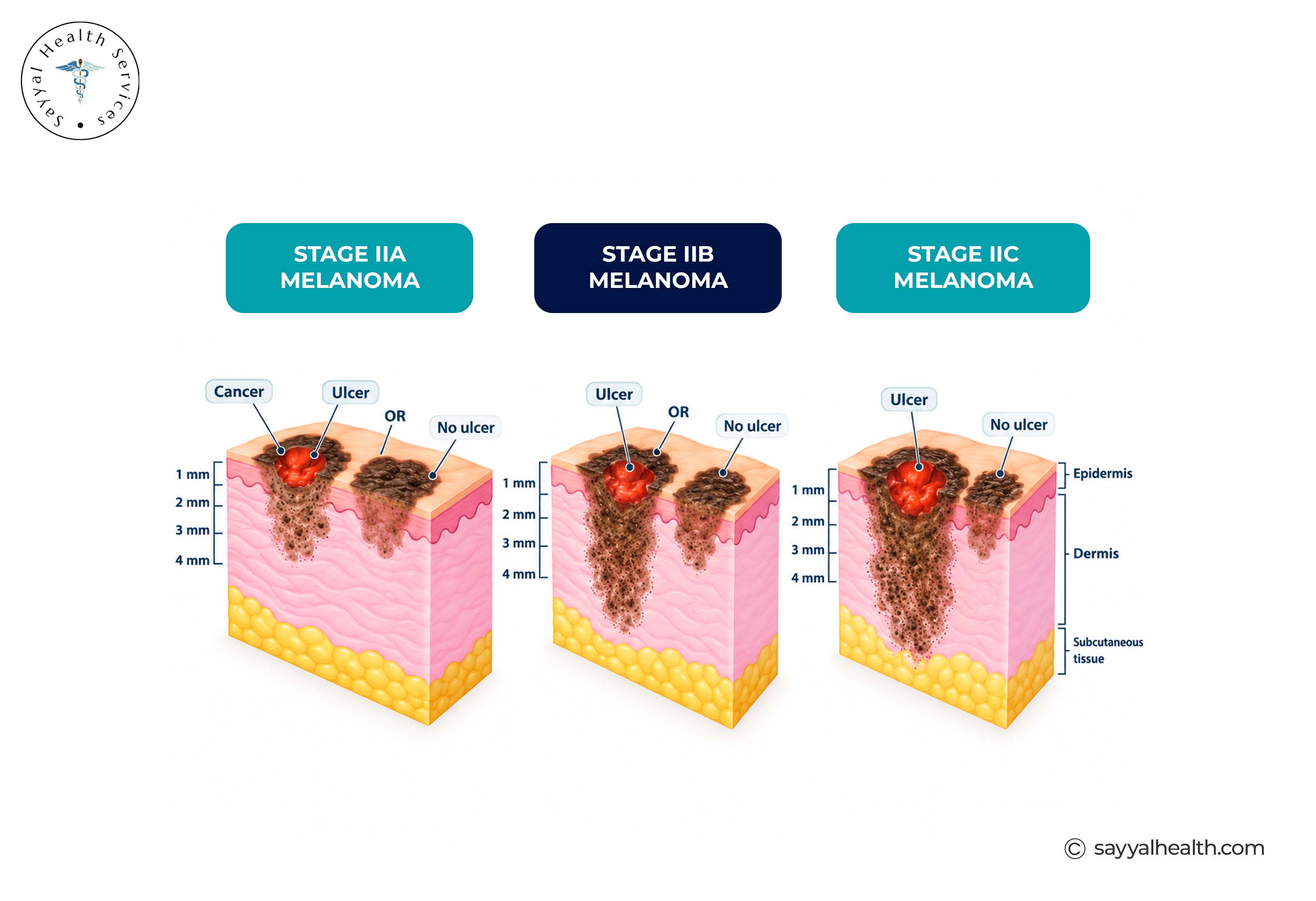stage 2 melanoma