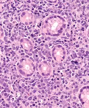 Success in the fight against cancer with vitamin C