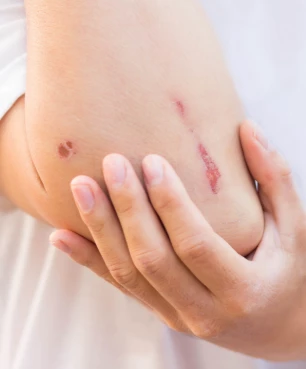 Vitamin C helps wounds heal