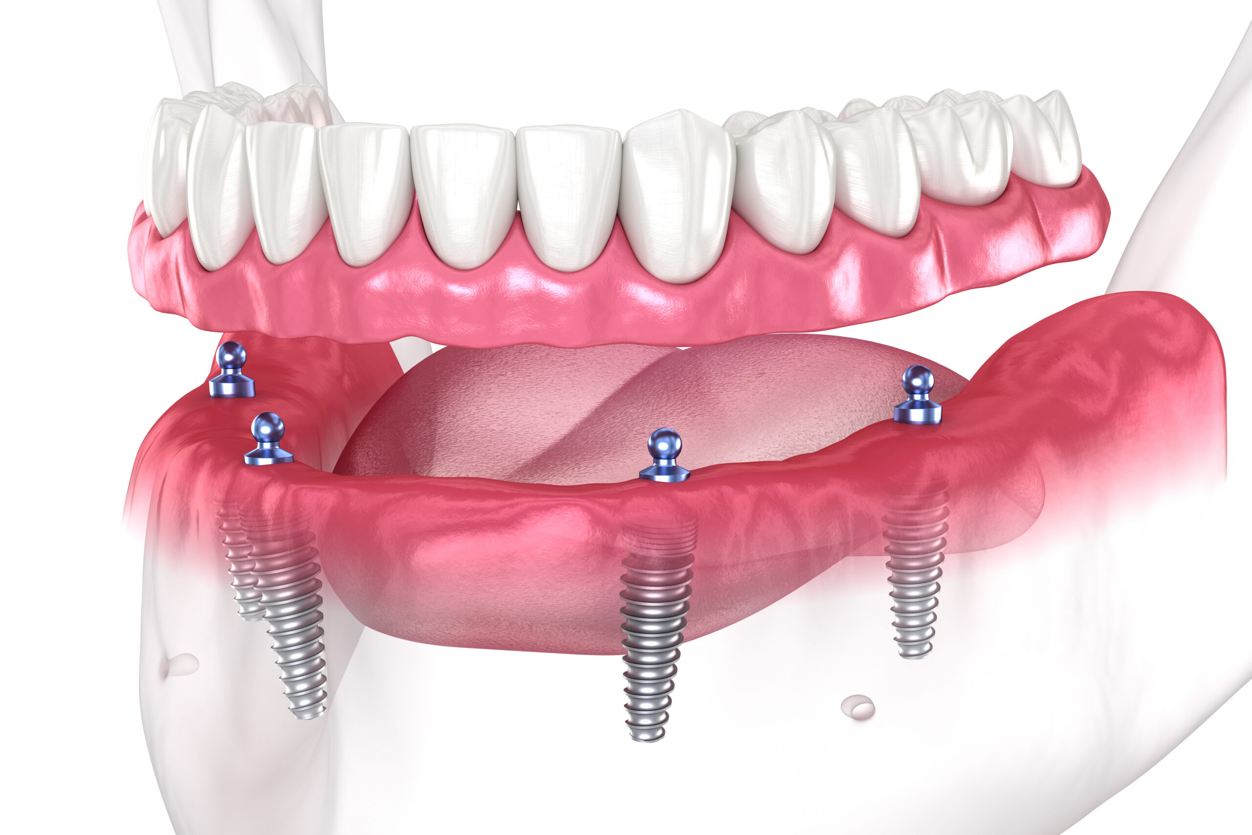 Benefits of Dental Implants