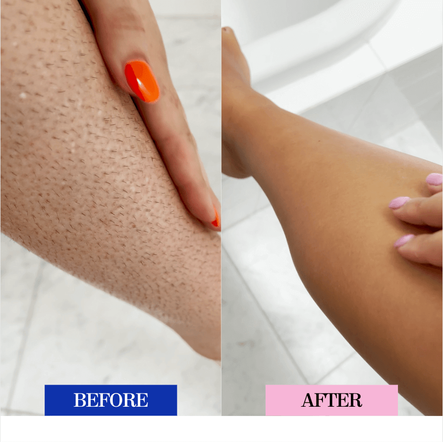 Laser Hair Removal Benefits