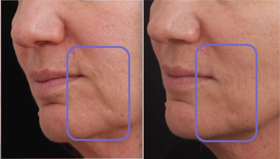 How Does RF Microneedling Work?